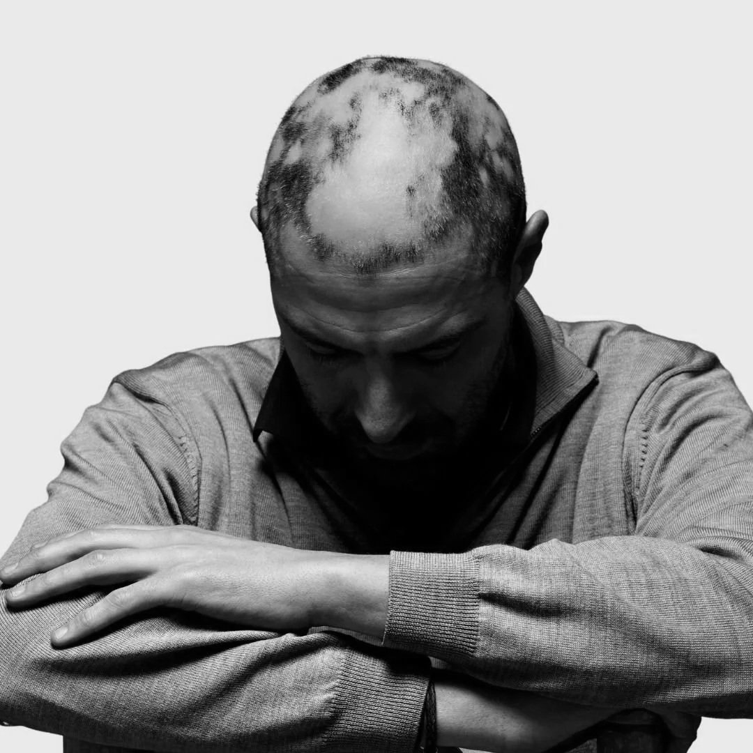 do you have alopecia areata?