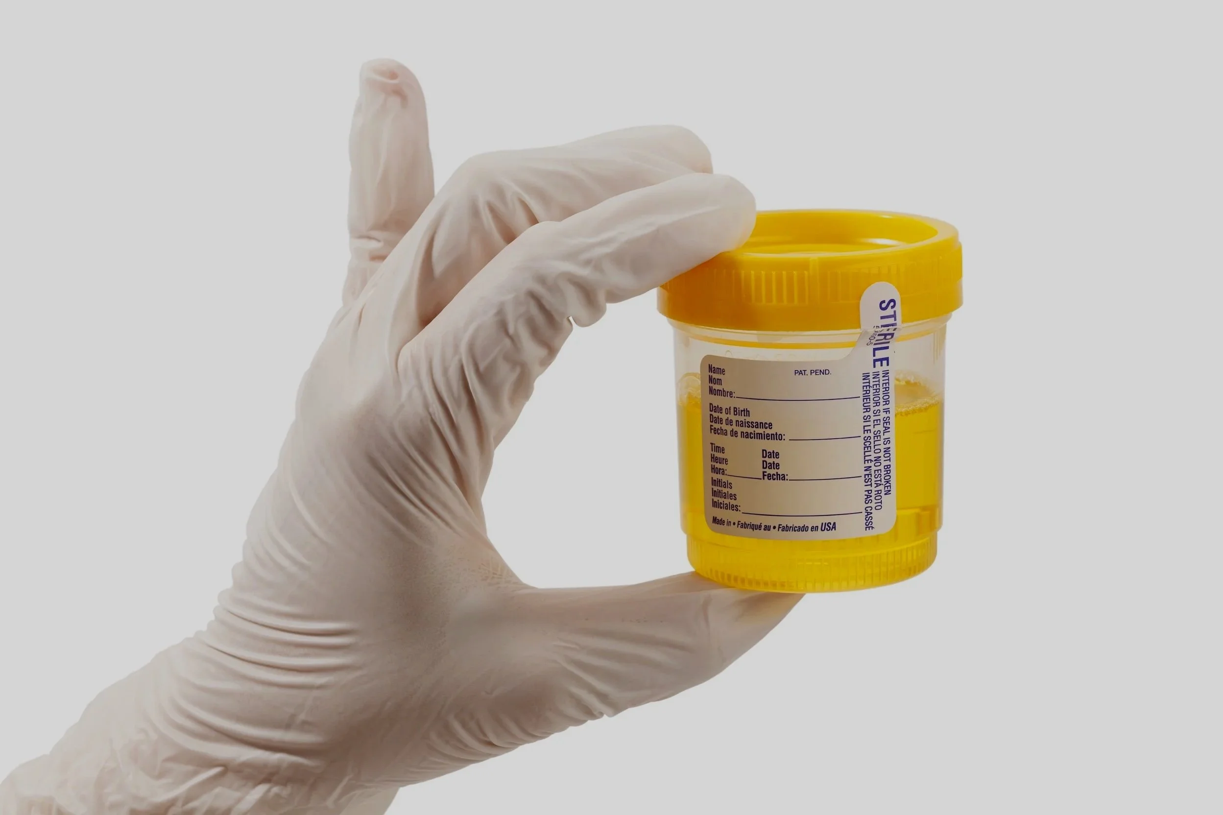 A hand wearing a latex glove holding a yellow-capped urine sample container with a white label and blue text.