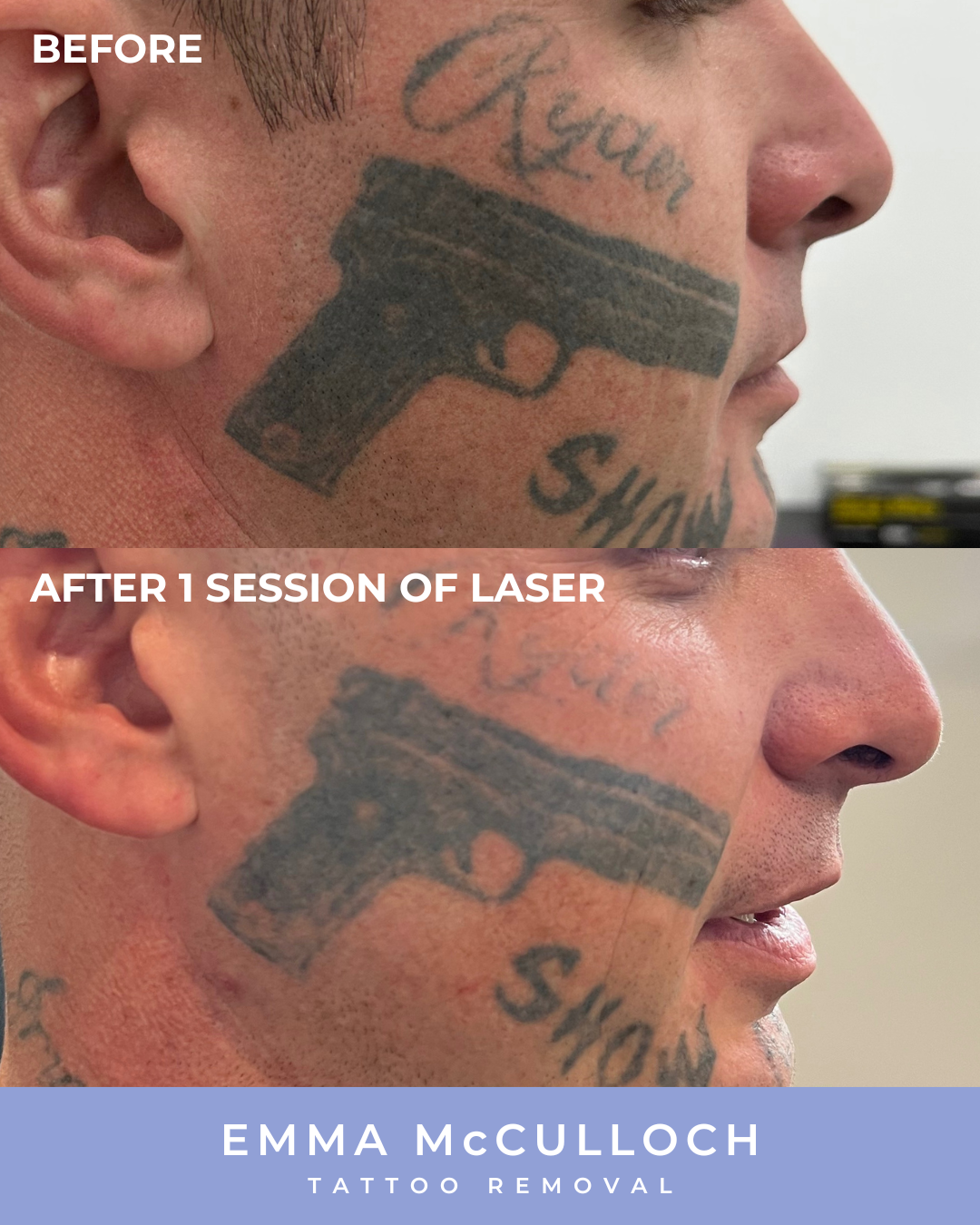 Body tattoo removal before and after in Everton Park, Brisbane