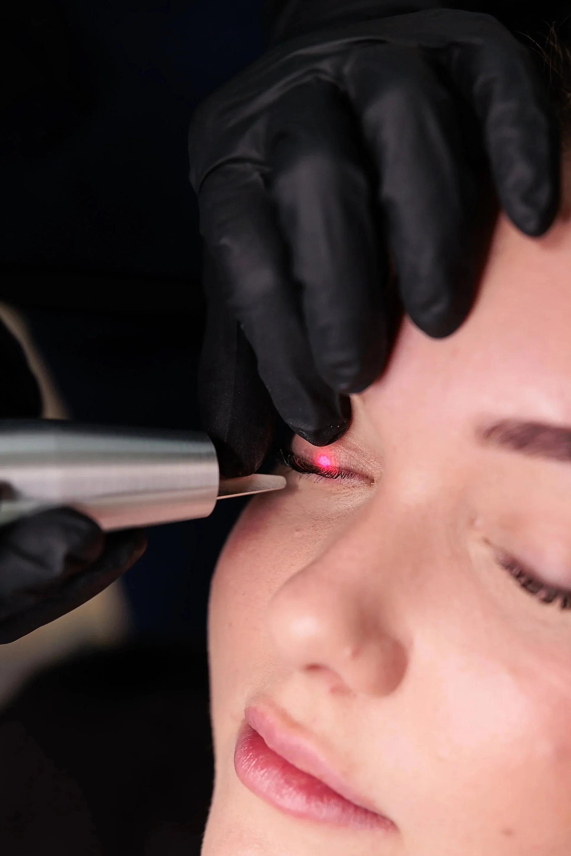 Eyeliner Tattoo Removal in Everton Park, Brisbane