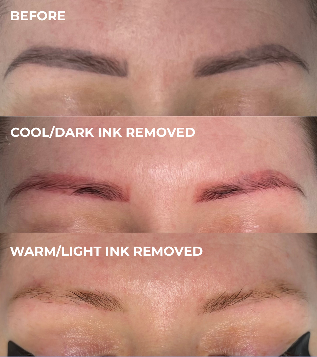 Brow tattoo removal before and after at Emma McCulloch Tattoo Removal in Everton Park, Brisbane