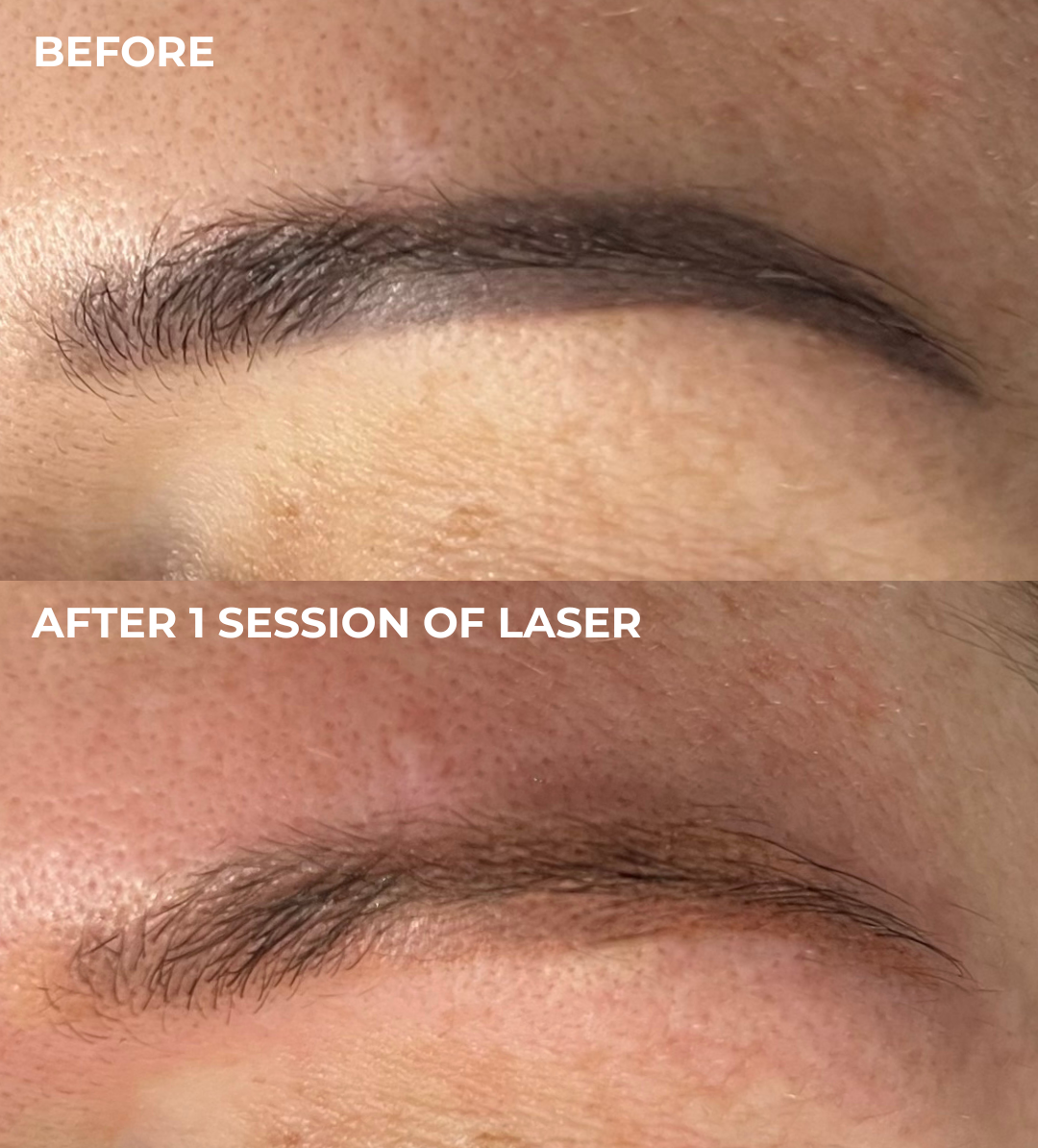 Laser brow tattoo removal result in Everton Park, Brisbane