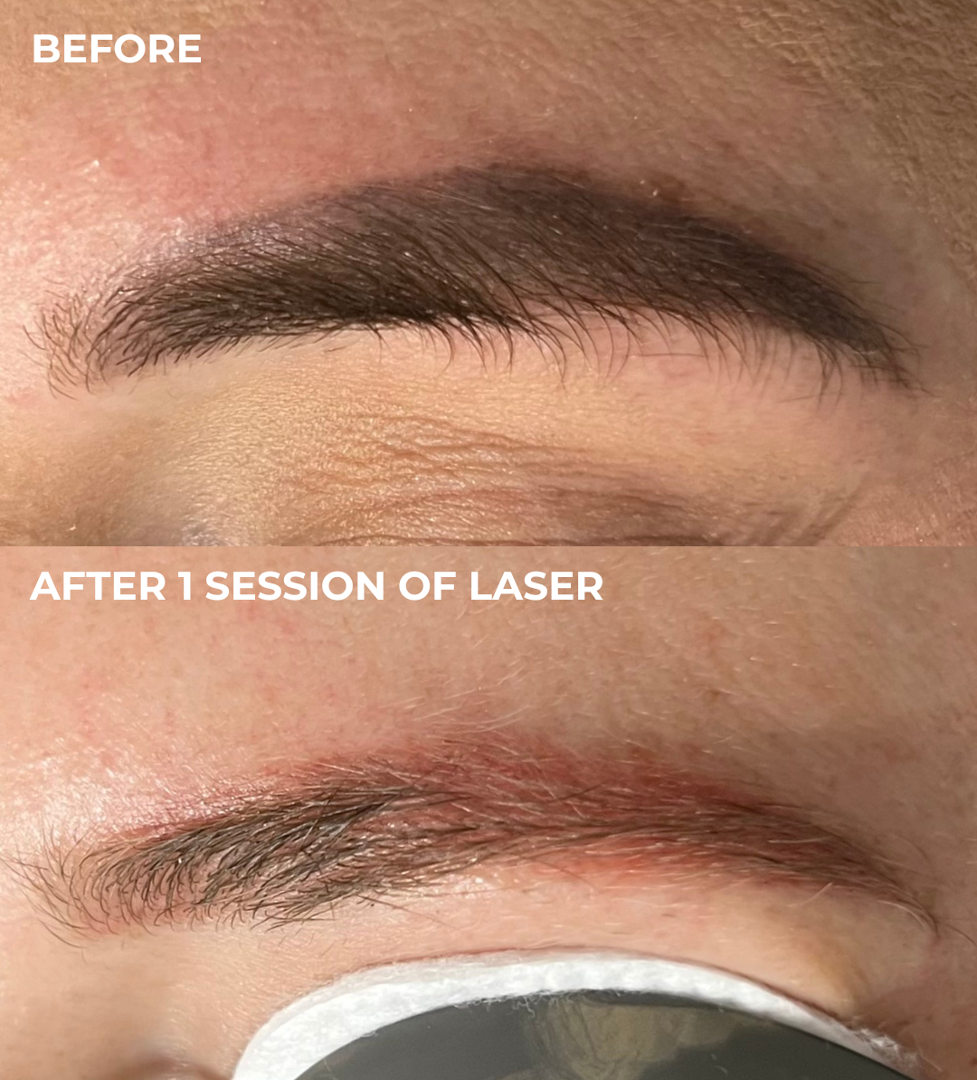 Brow tattoo lightening result at Emma McCulloch Tattoo Removal, Everton Park Brisbane