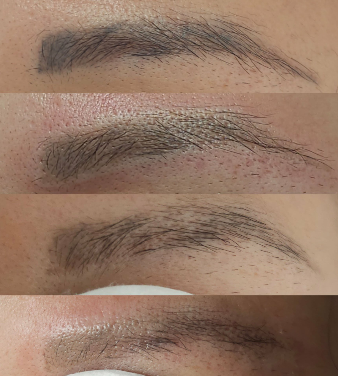Cosmetic brow tattoo removal before and after in Brisbane