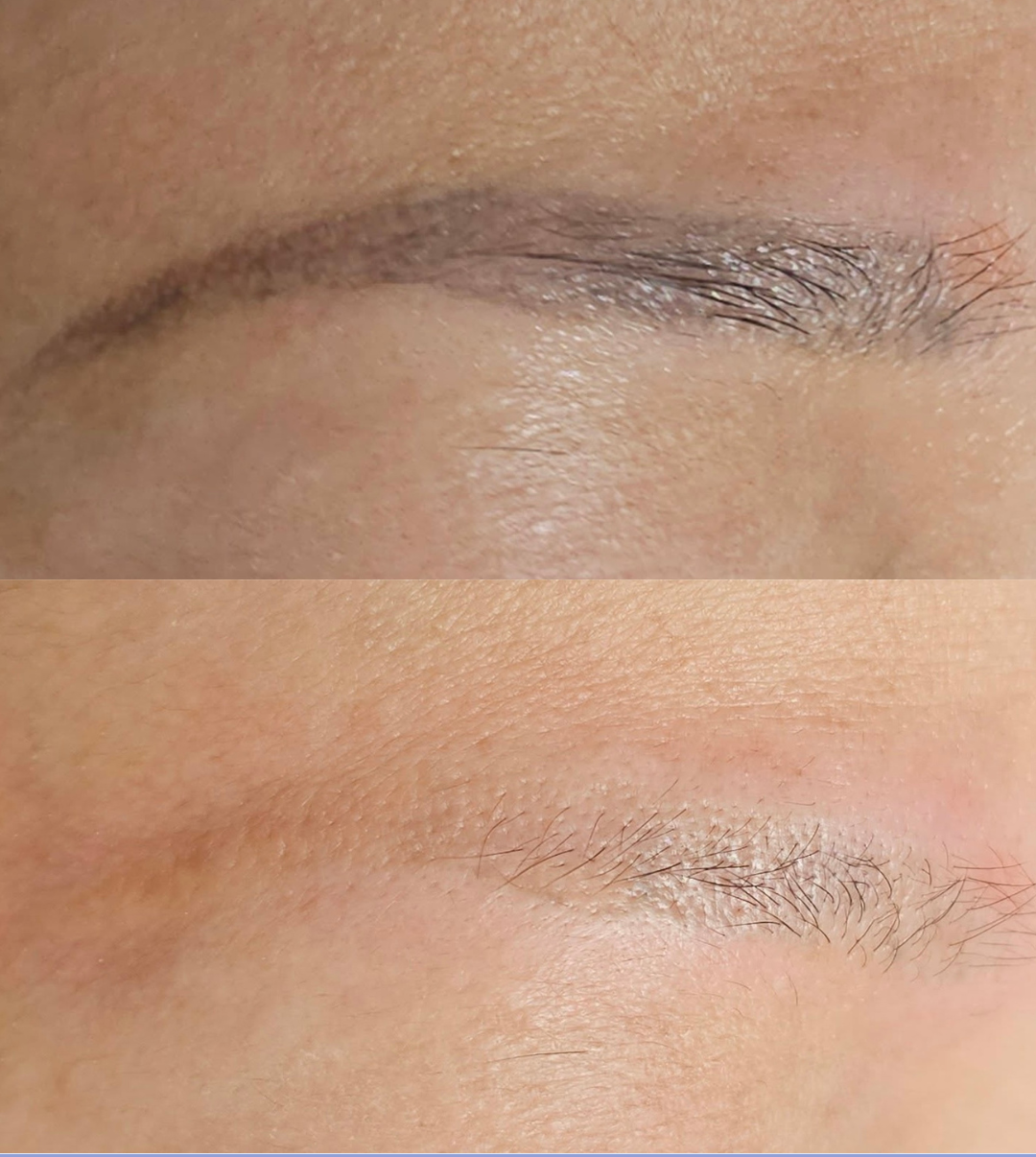 Brow tattoo removal before and after at Emma McCulloch Tattoo Removal in Everton Park, Brisbane