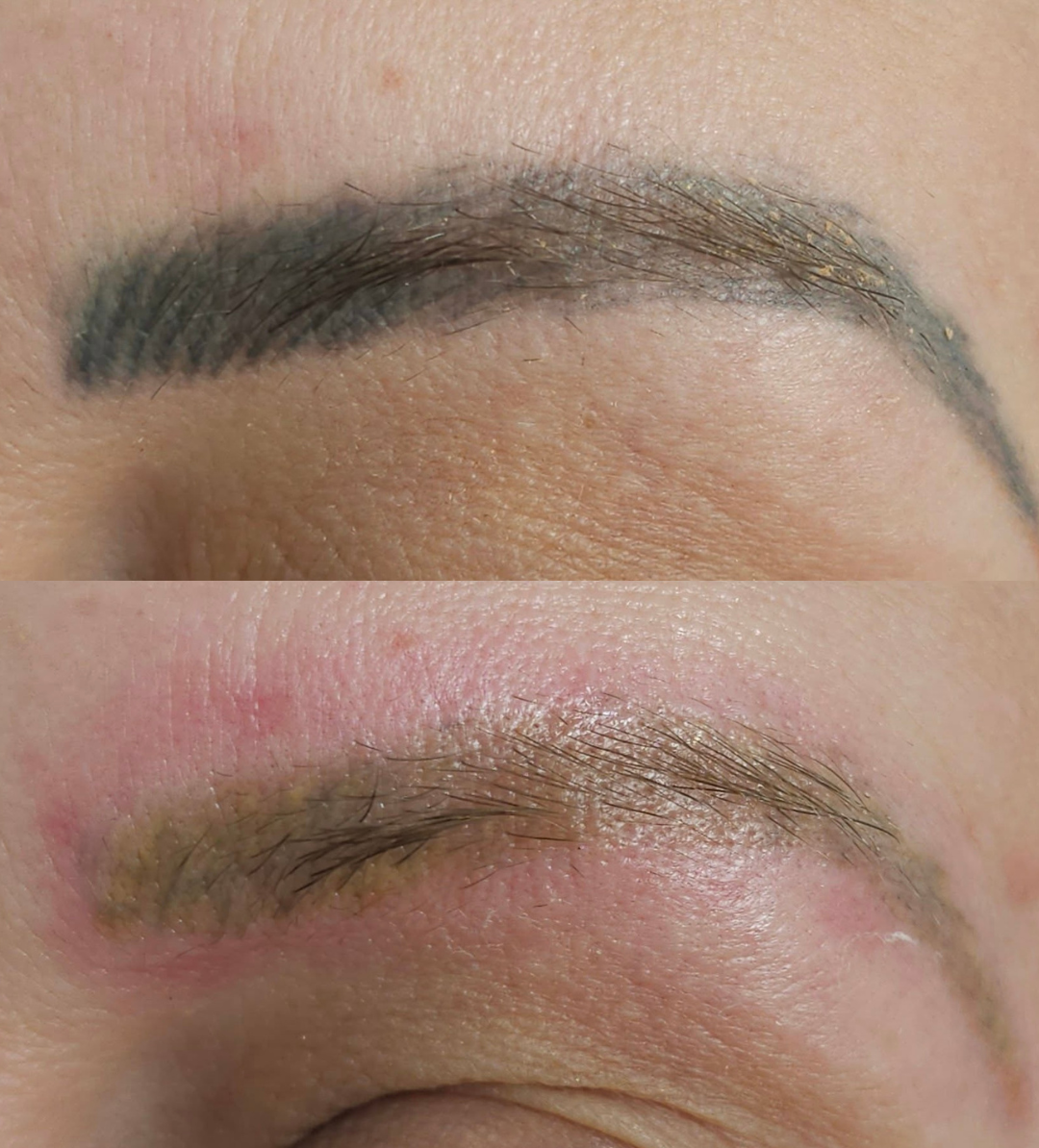 Laser brow tattoo removal result in Everton Park, Brisbane