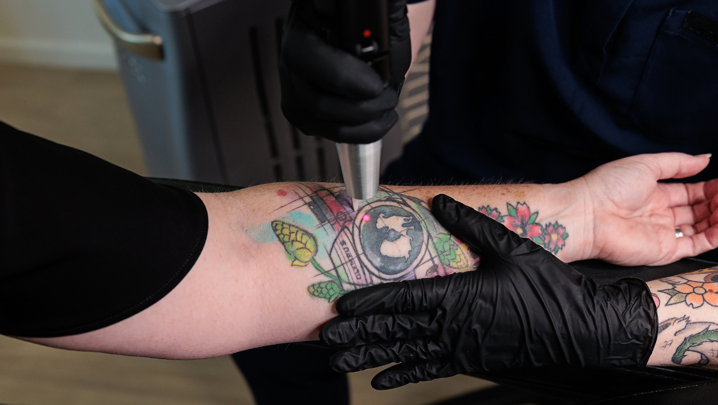 Body tattoo before laser removal treatment