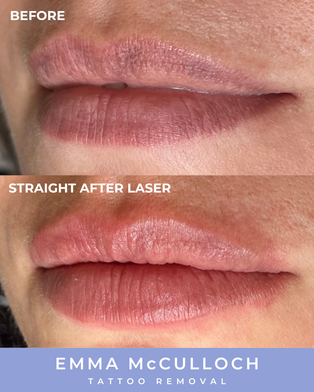 Lip blush tattoo removal result at Emma McCulloch Tattoo Removal, Everton Park Brisbane