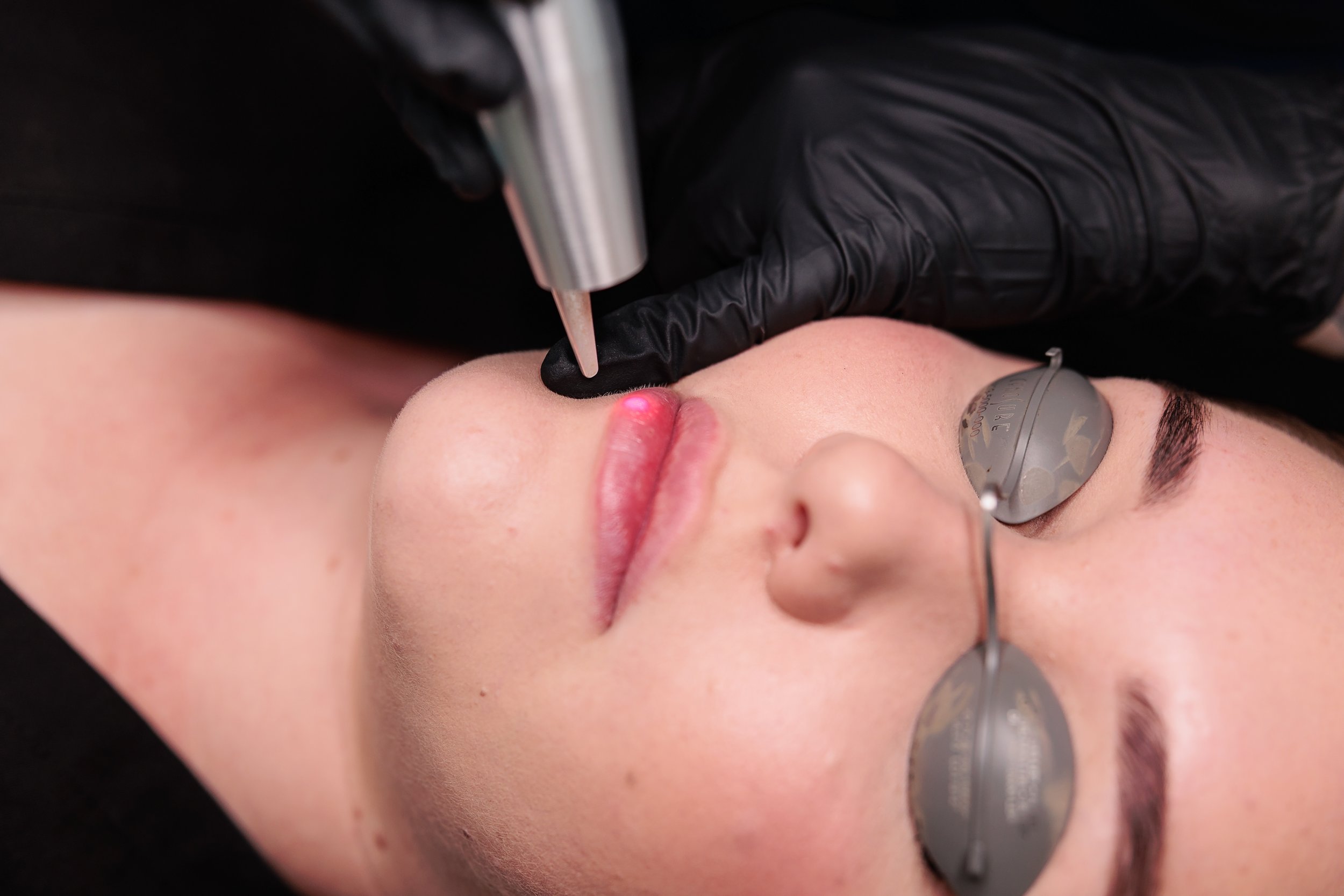 Lip Tattoo Removal in Everton Park, Brisbane