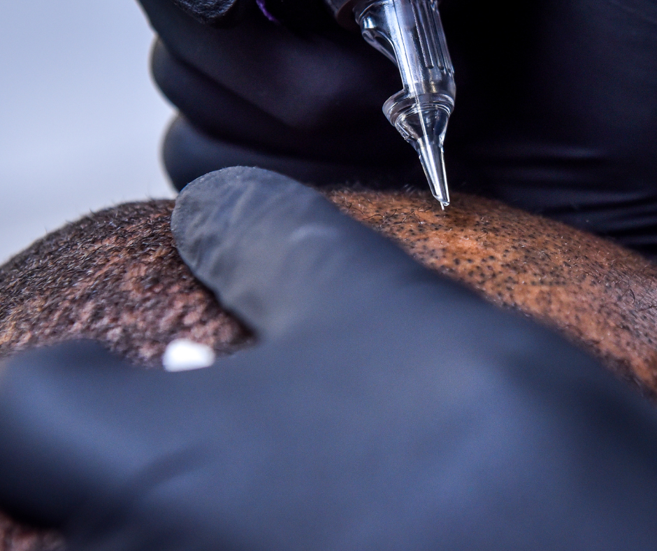 Scalp micropigmentation before removal treatment