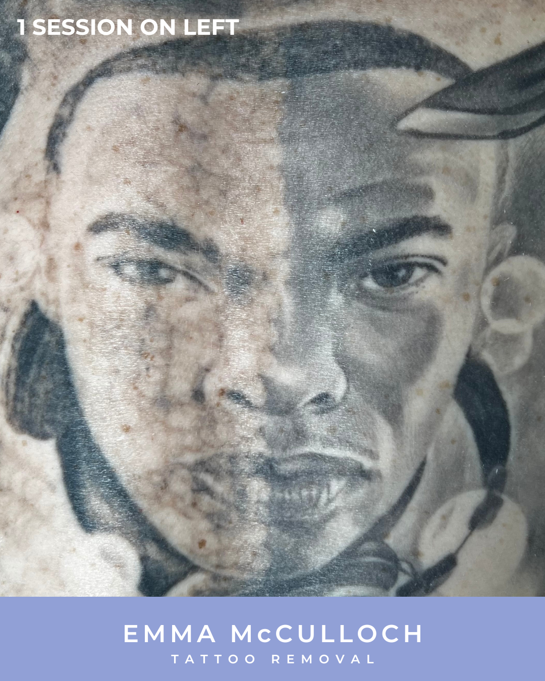 Multicolour body tattoo removal before and after at Emma McCulloch Tattoo Removal in Everton Park, Brisbane