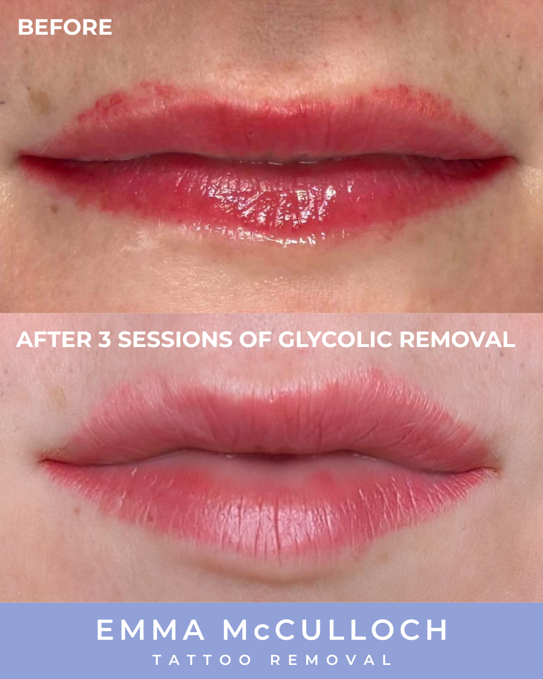 INSTA Lip Before & After .png