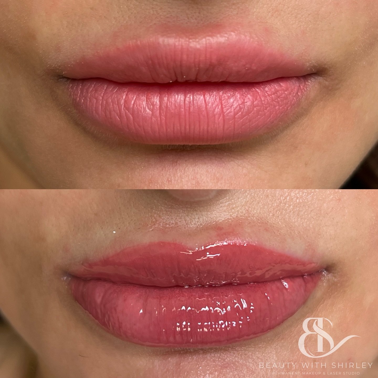 My client had previous lip blush done before but her lips still lacked a defined shape and she just wanted them more rosy mauve pink.

She was so happy with the cute little cupids bow that I achieved for her 🥰

All it needed was a bit of shaping and