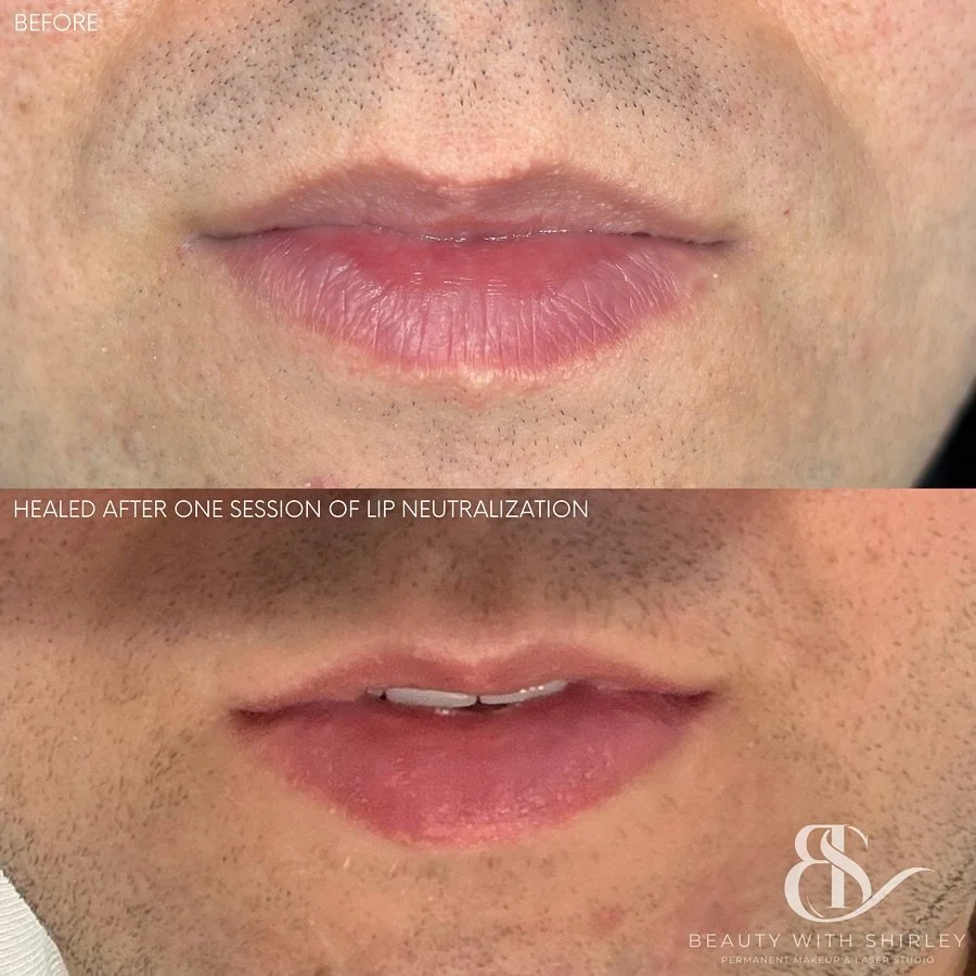 Lip Blush and Lip Neutralization are not just for women. Men can absolutely benefit from this treatment as well.

My client came in because his upper lip was naturally darker and he wanted a more even toned colour overall. He also had some scarring a