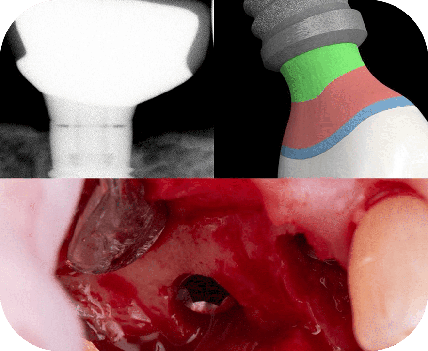 Implant Prosthetics and Multi-Implant Placement