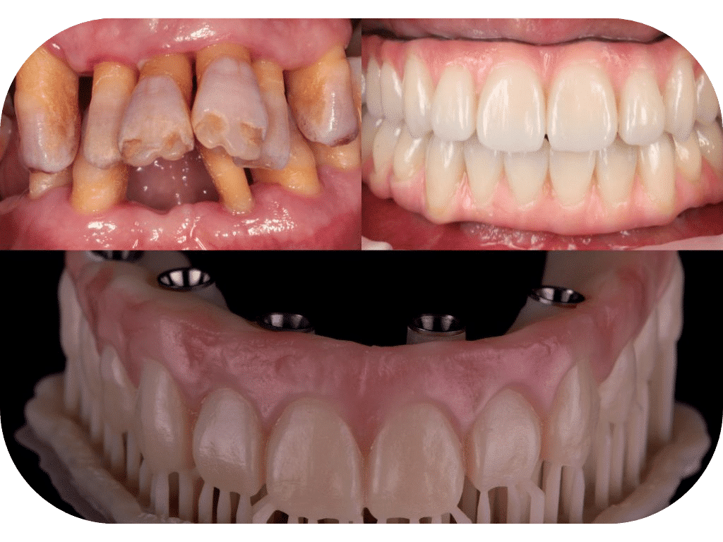 Full Arch Rehabilitation