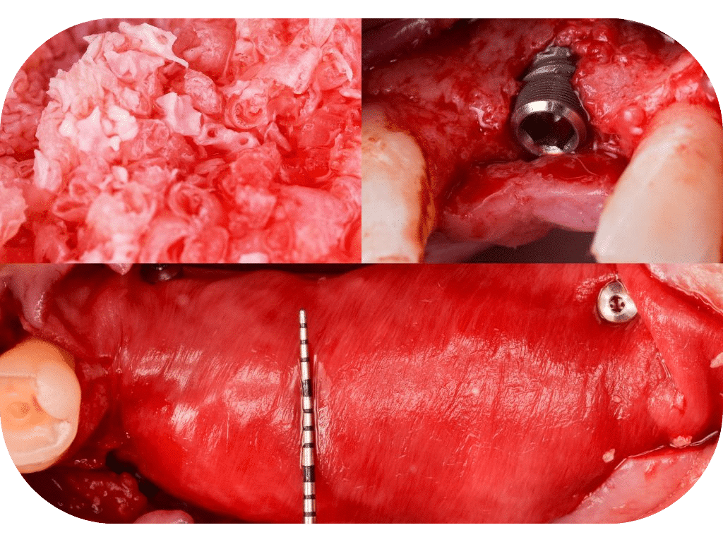 Implants with GBR & Sinus