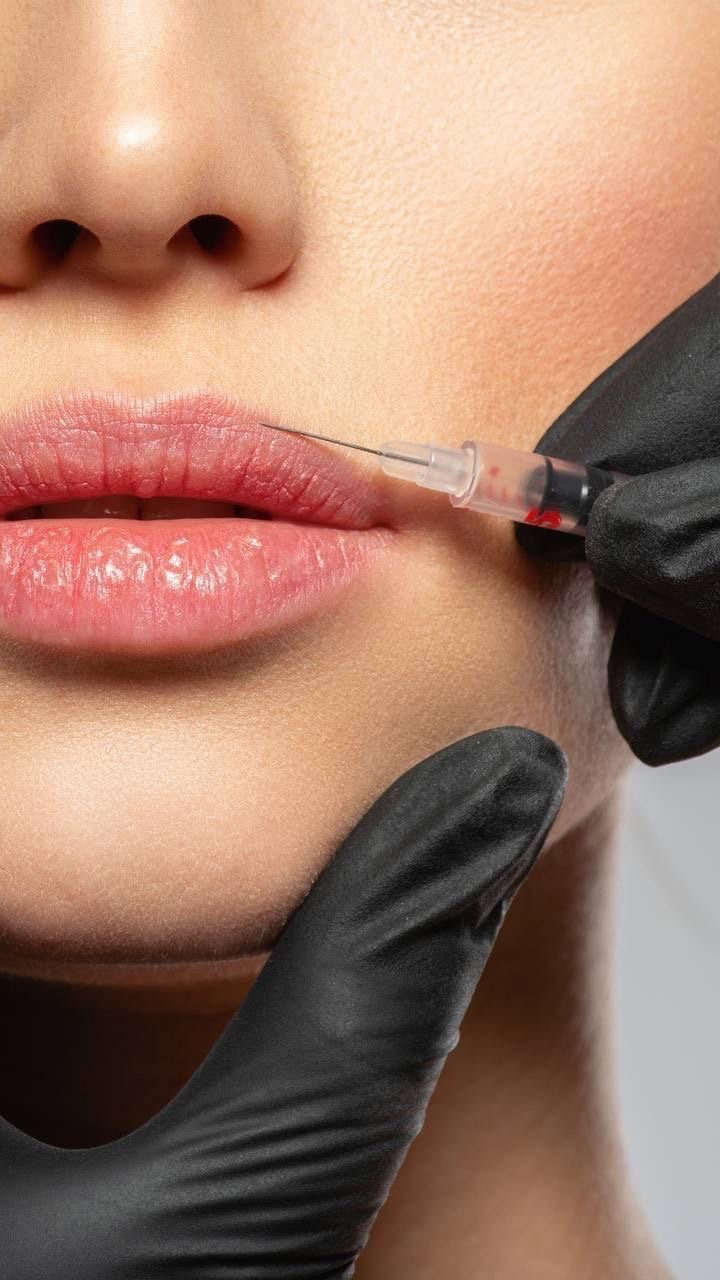 Close-up of a person receiving a lip injection from a medical professional wearing black gloves.