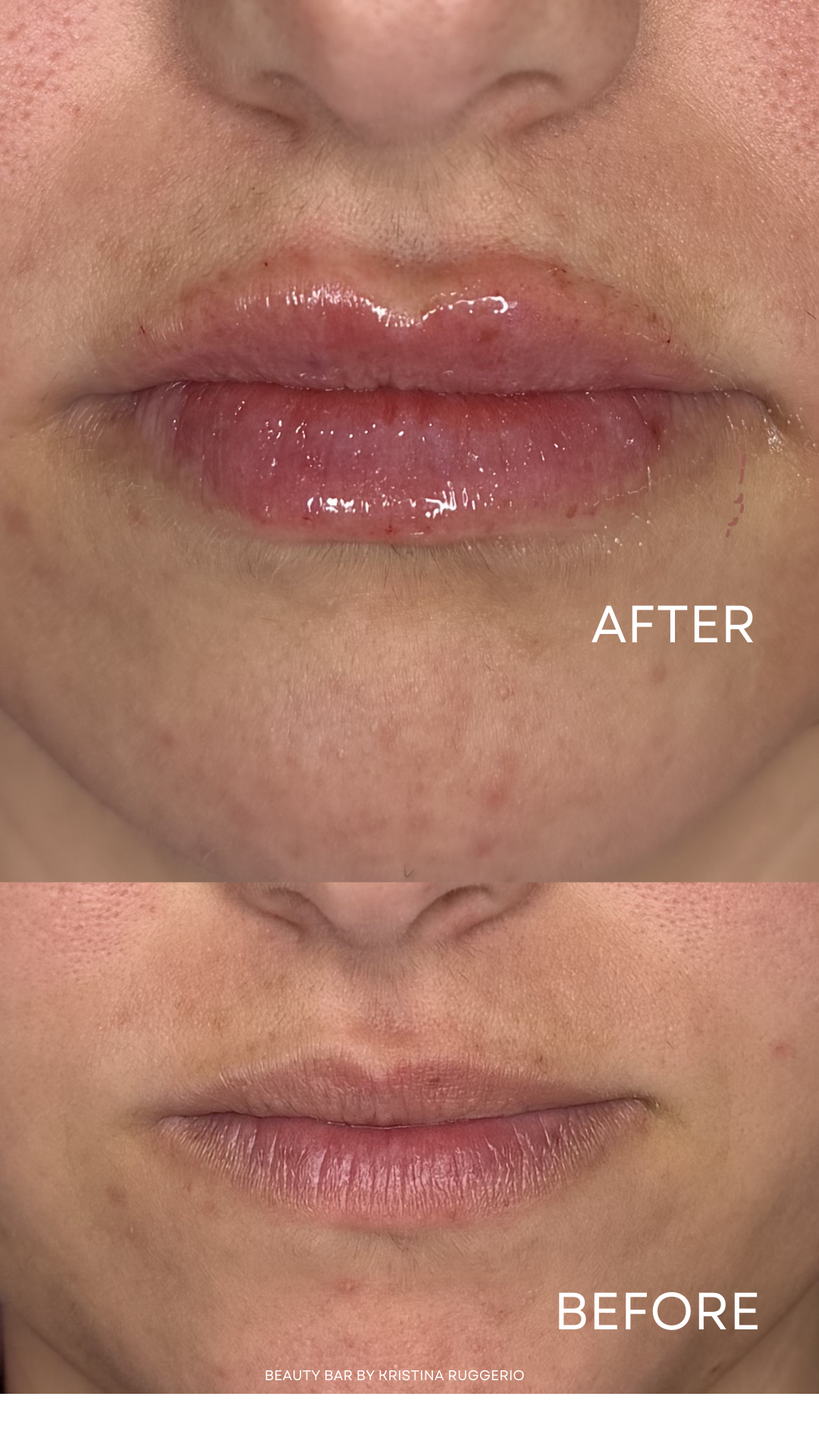 Before & After Using Lip Filler.