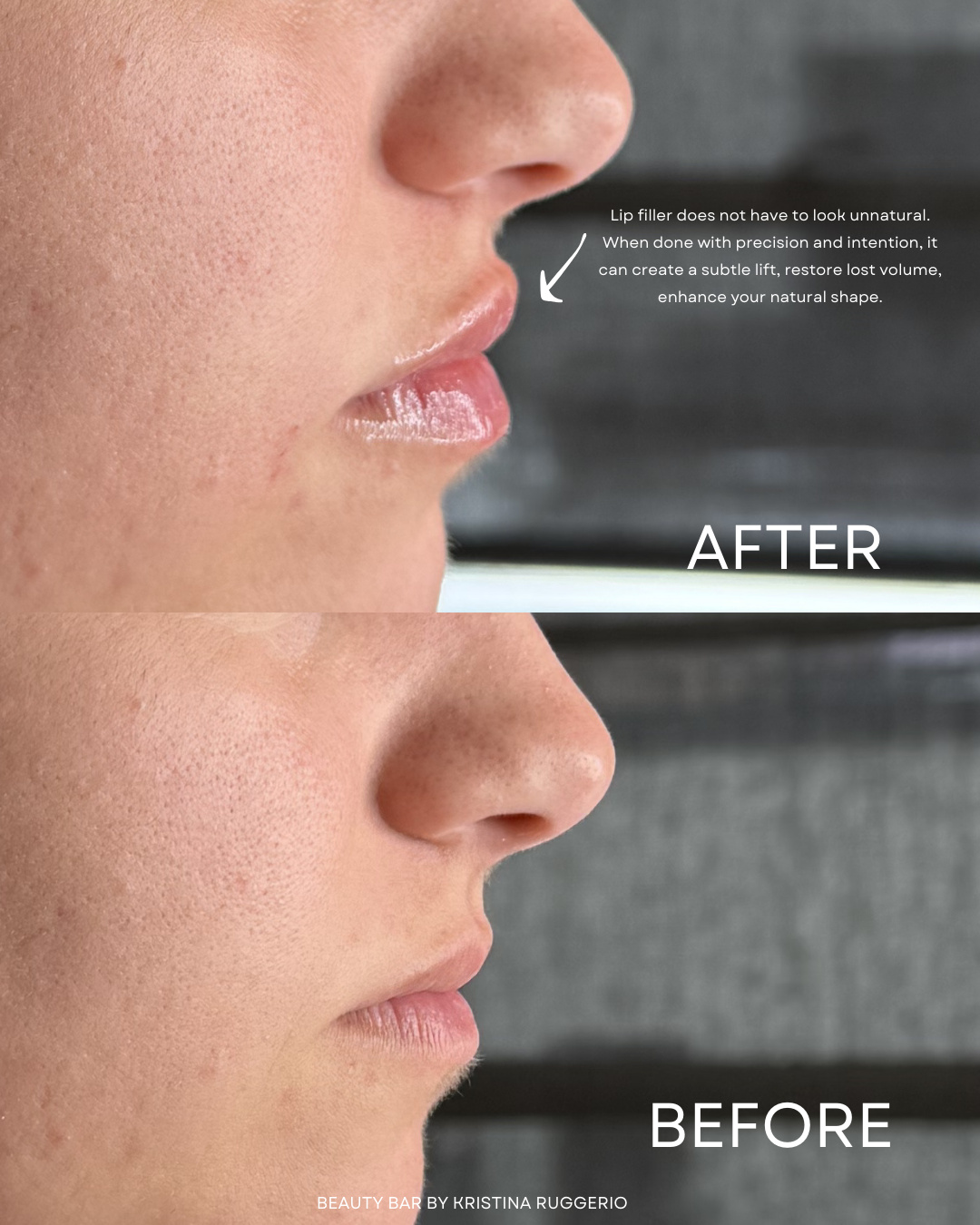 Before & After Using Lip Filler