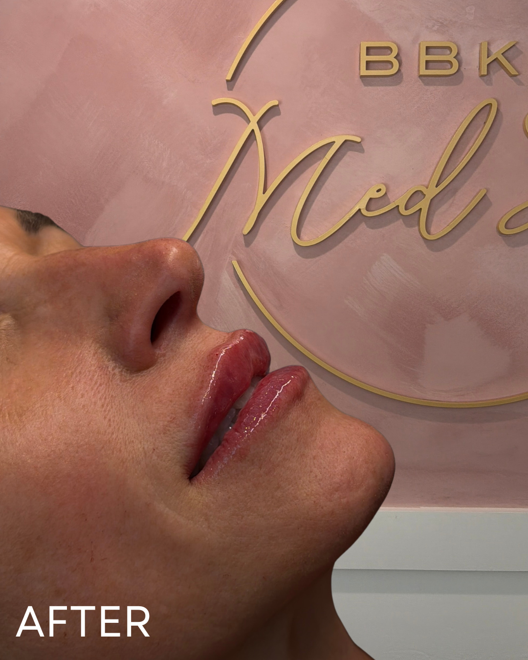 KATIE LIP FILLER B&A.png