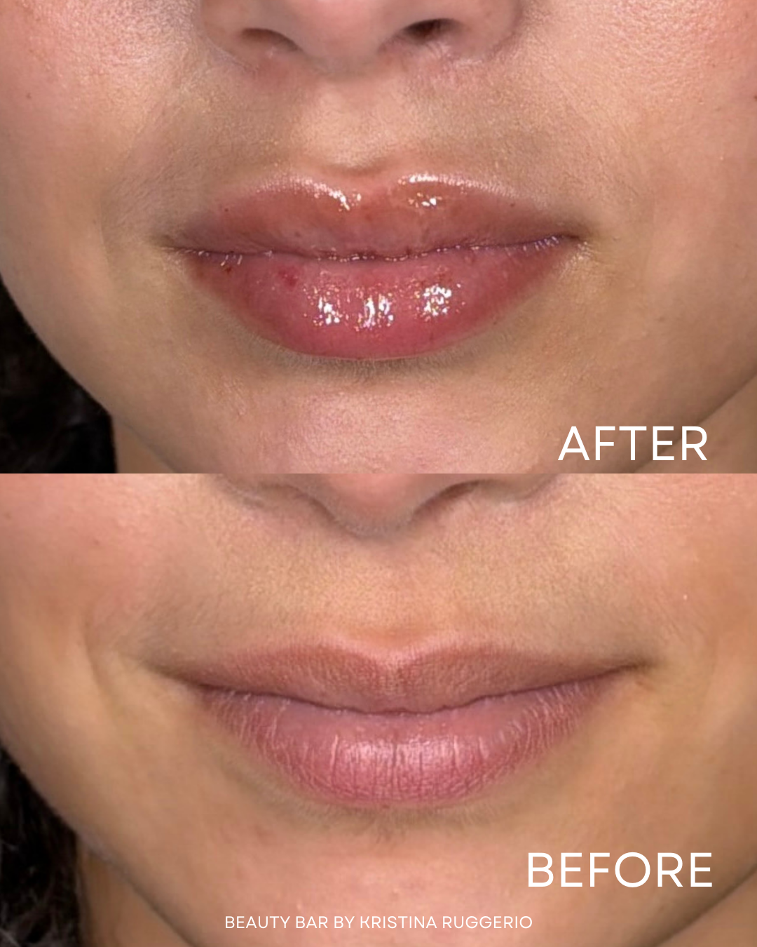 Lip Flip Using Botox