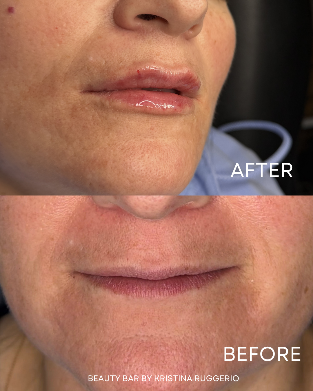 Before & After Using Lip Filler