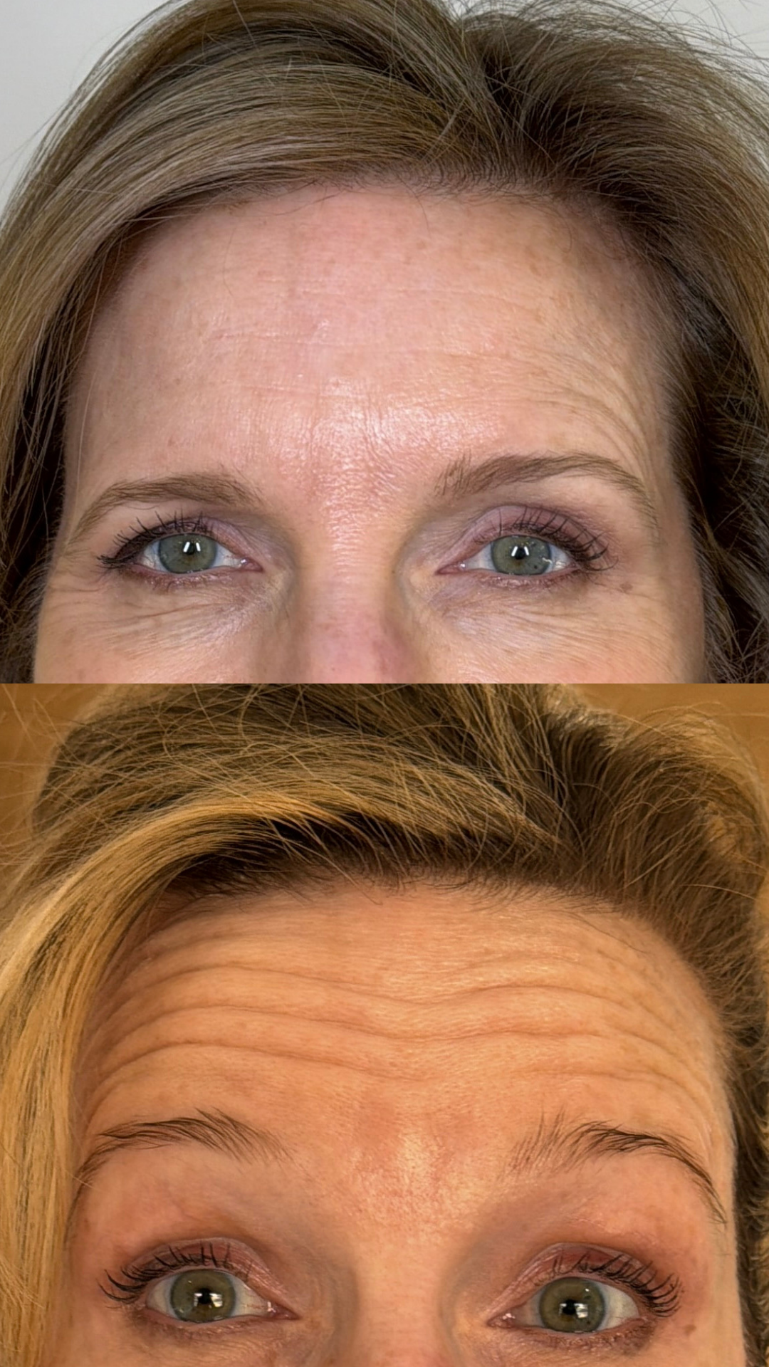 Before & After Using Xeomin.