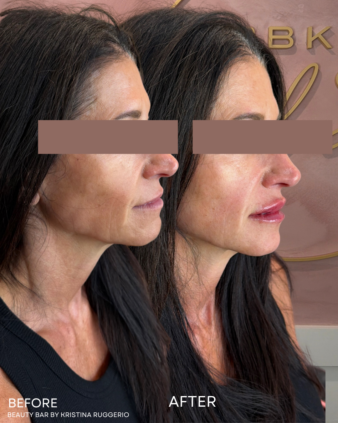 KATIE LIP FILLER B&A (1).png