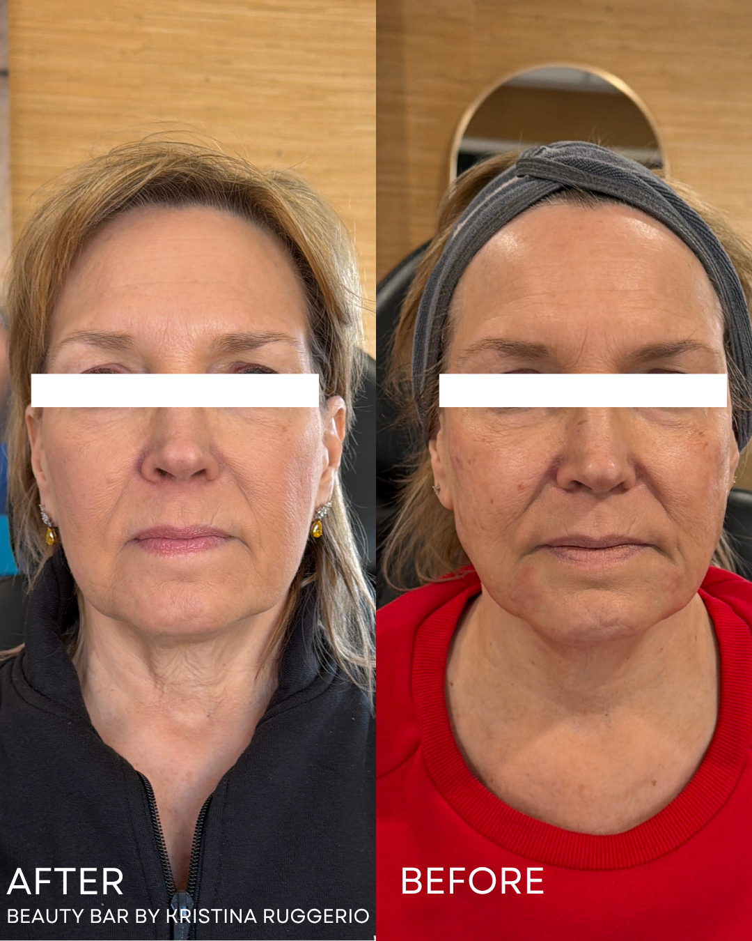 3 months fully healed. Side-by-side results using 2 vials of Radiesse biostimulator.