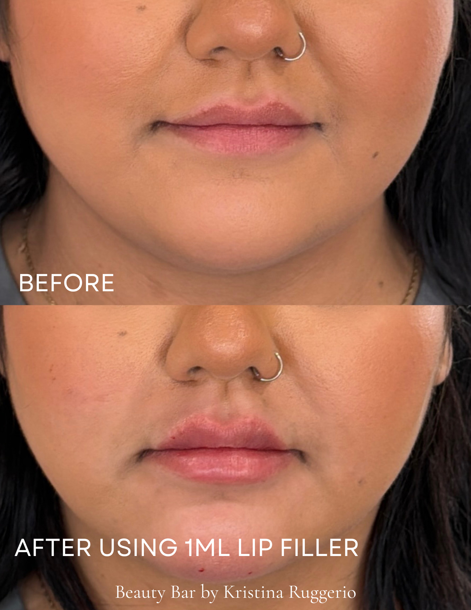 Close-up photo showing the before and after results of lip enhancement with 1ml lip filler, featuring a woman with dark hair, a nose ring, and subtle makeup, highlighting fuller lips in the after image.