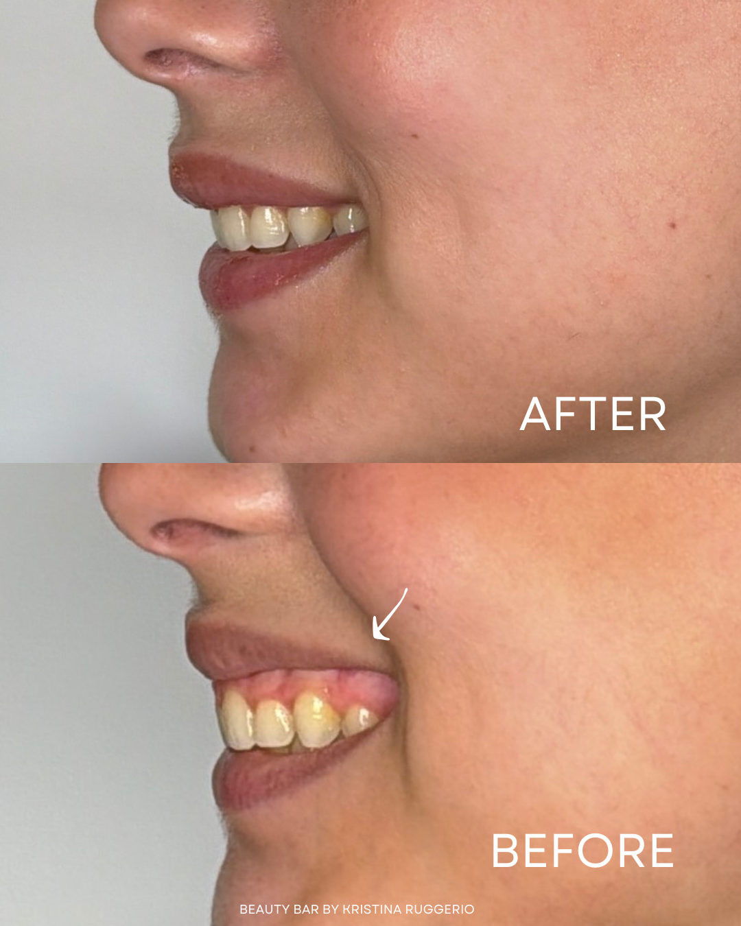 Lip Flip Using Botox, a Lip Flip is typically used to help hide "gummy smiles".