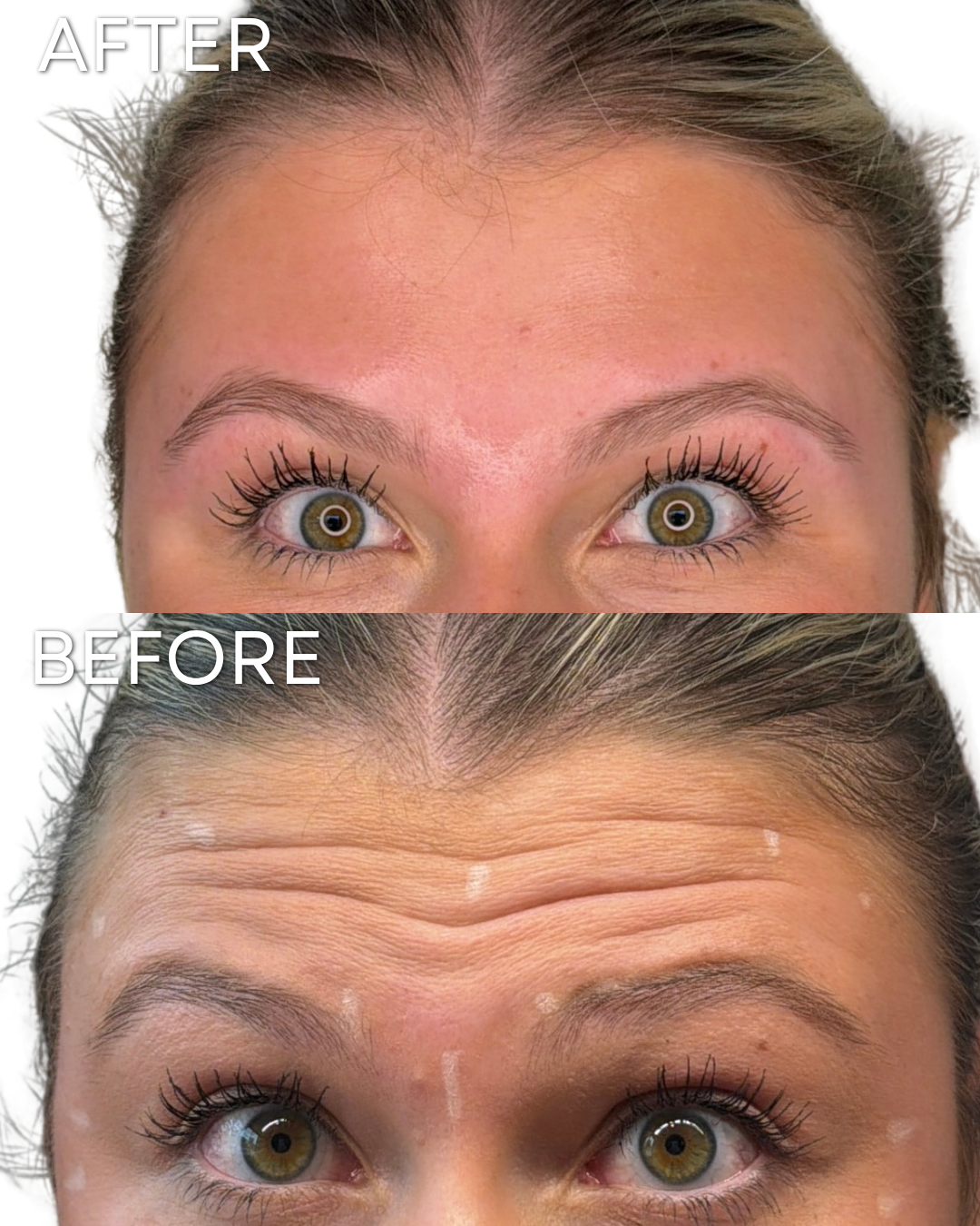 MADDIE BOTOX B&A.png