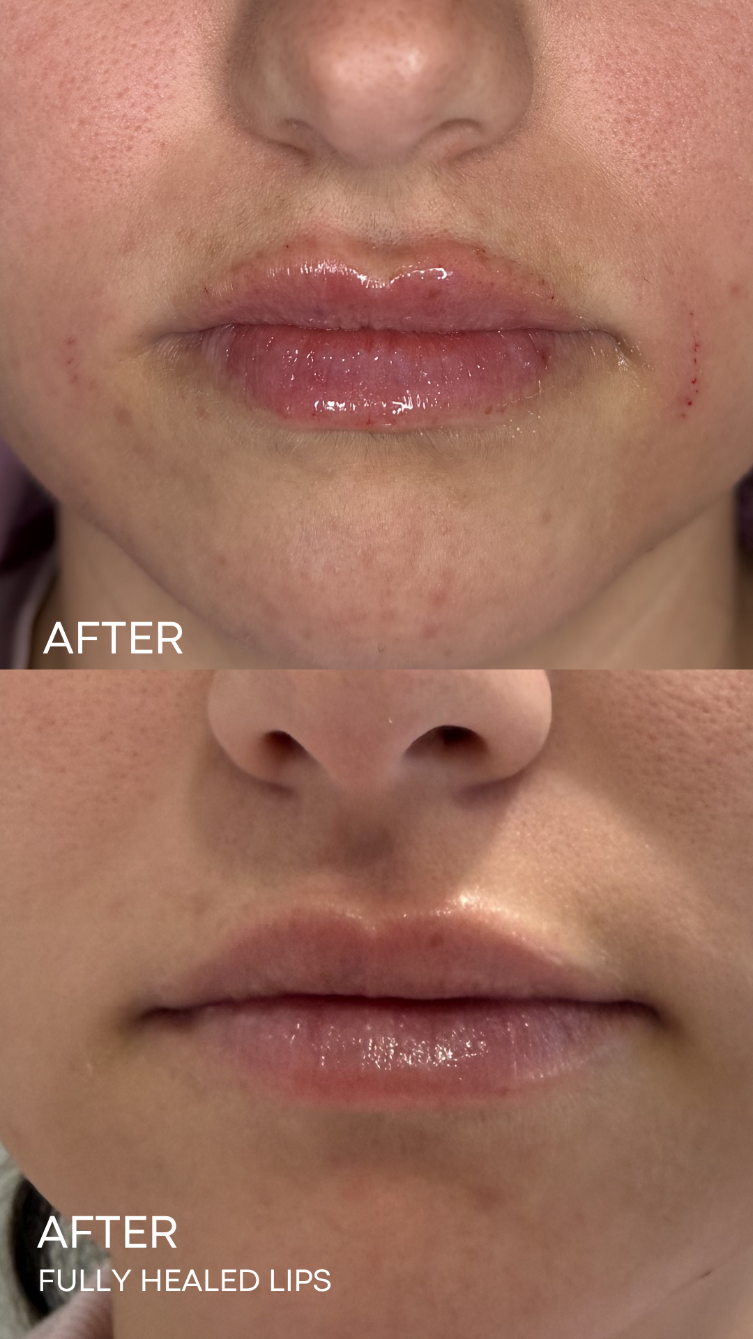 Fully Healed Lips Using Lip Filler. 