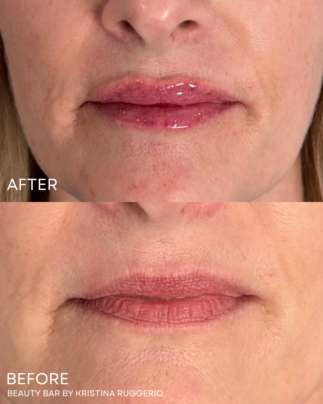 Before & After Using Lip Filler