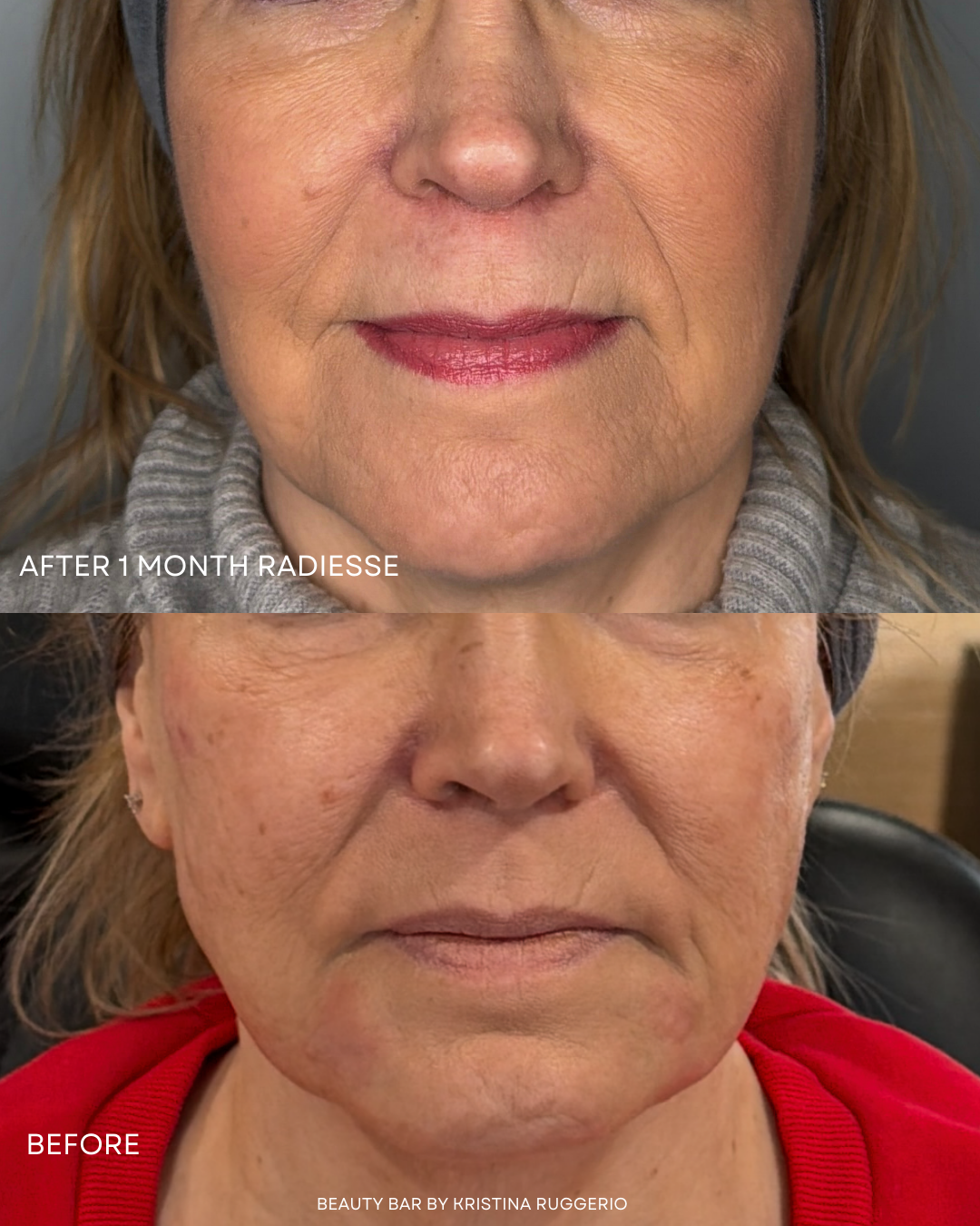 Side-by-side comparison of a woman's face before and after a skincare treatment. The top image shows her skin after one month of Radiesse treatment, with smoother texture and improved appearance. The bottom image shows her skin before the treatment, 