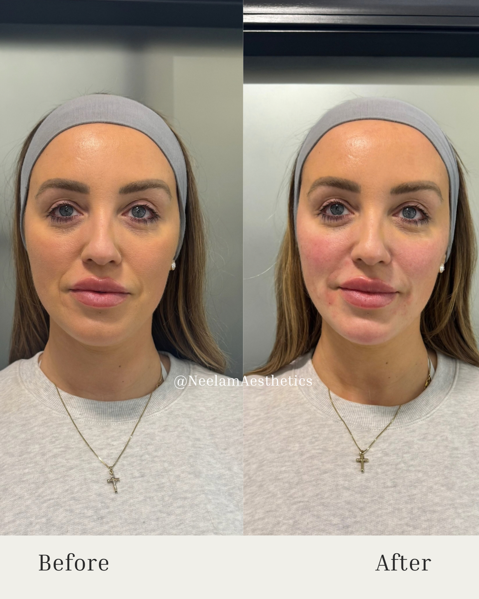 cheek filler, mid face and lower face balance