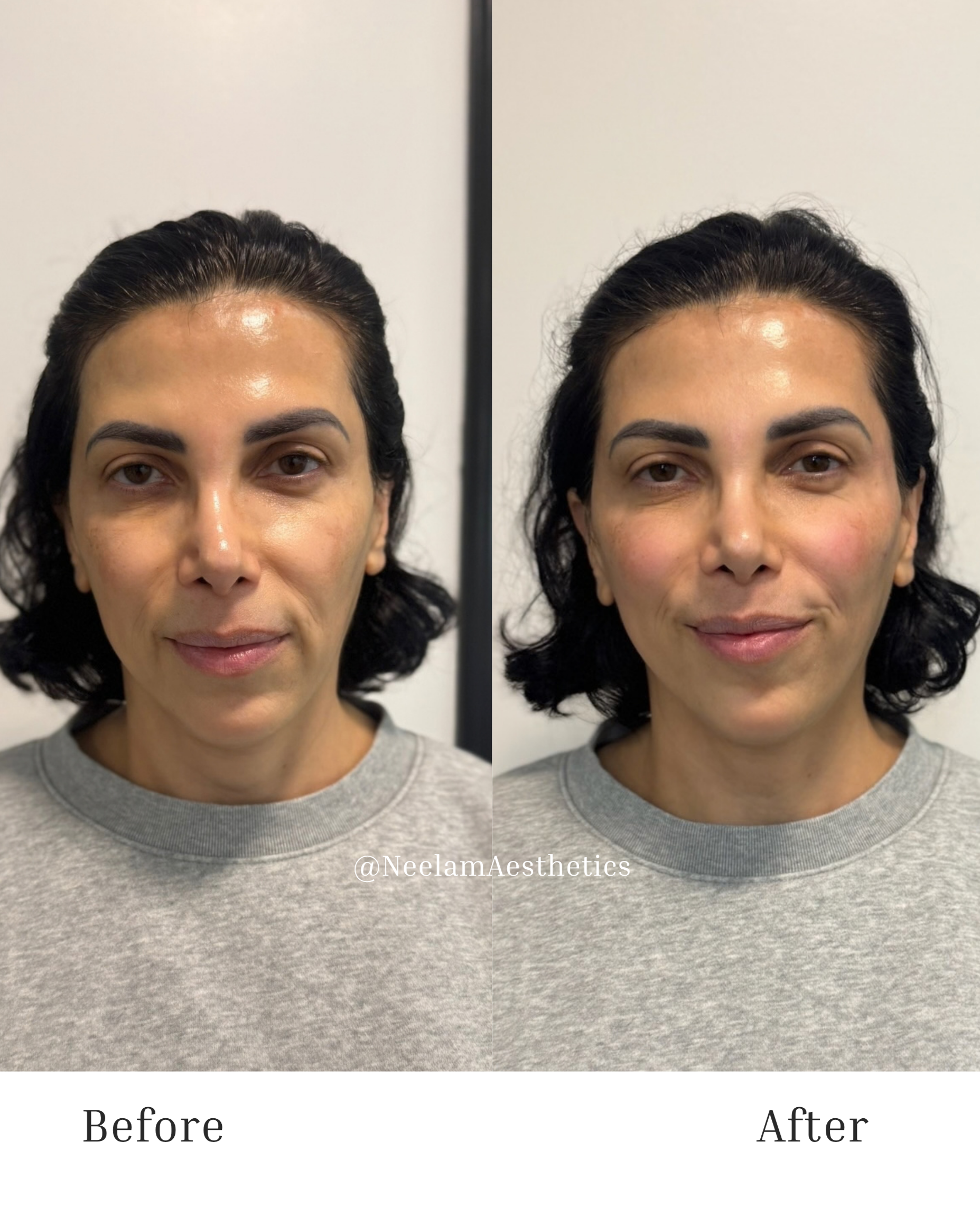 Full facial rejuvenation 