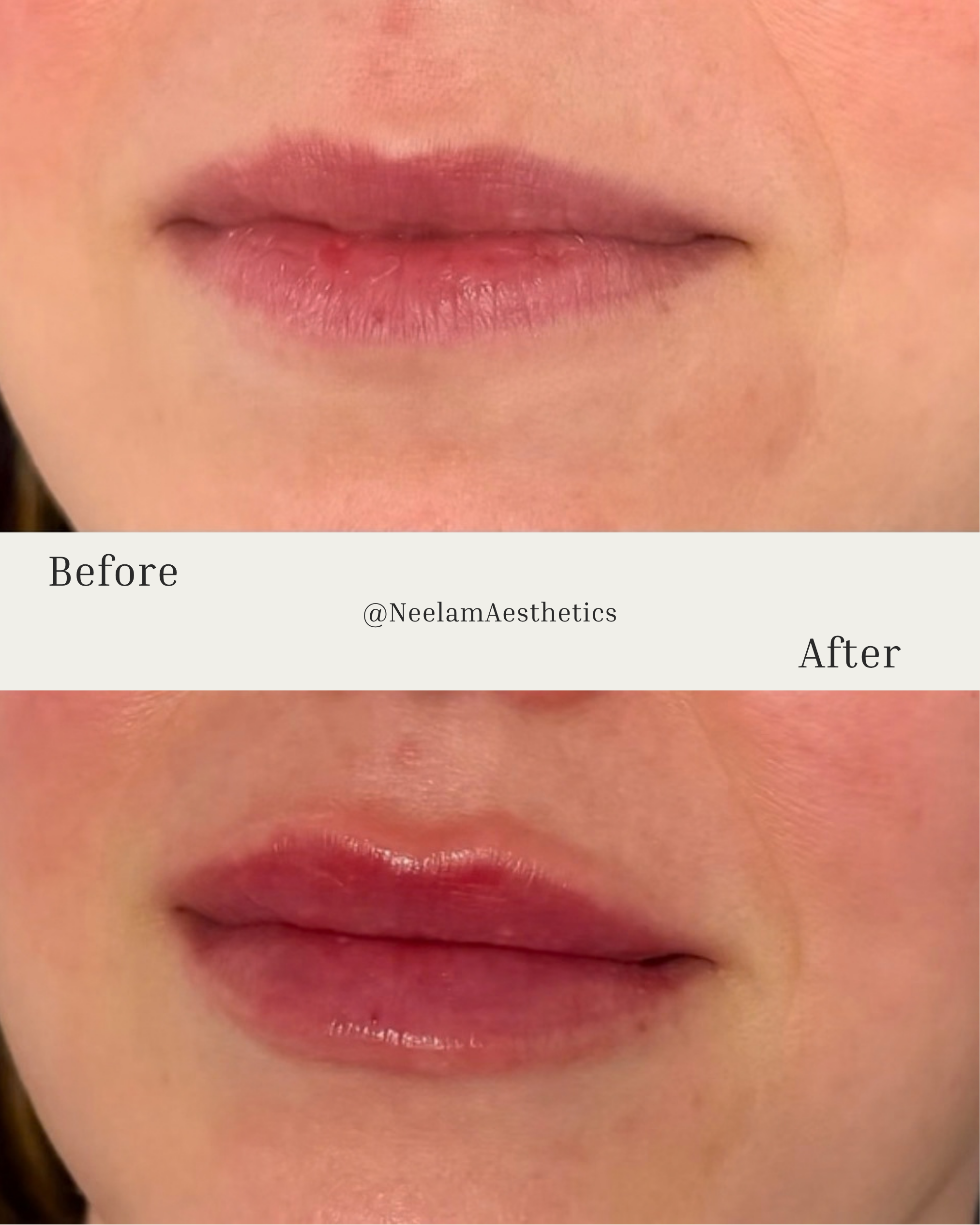 lip flip lip balance