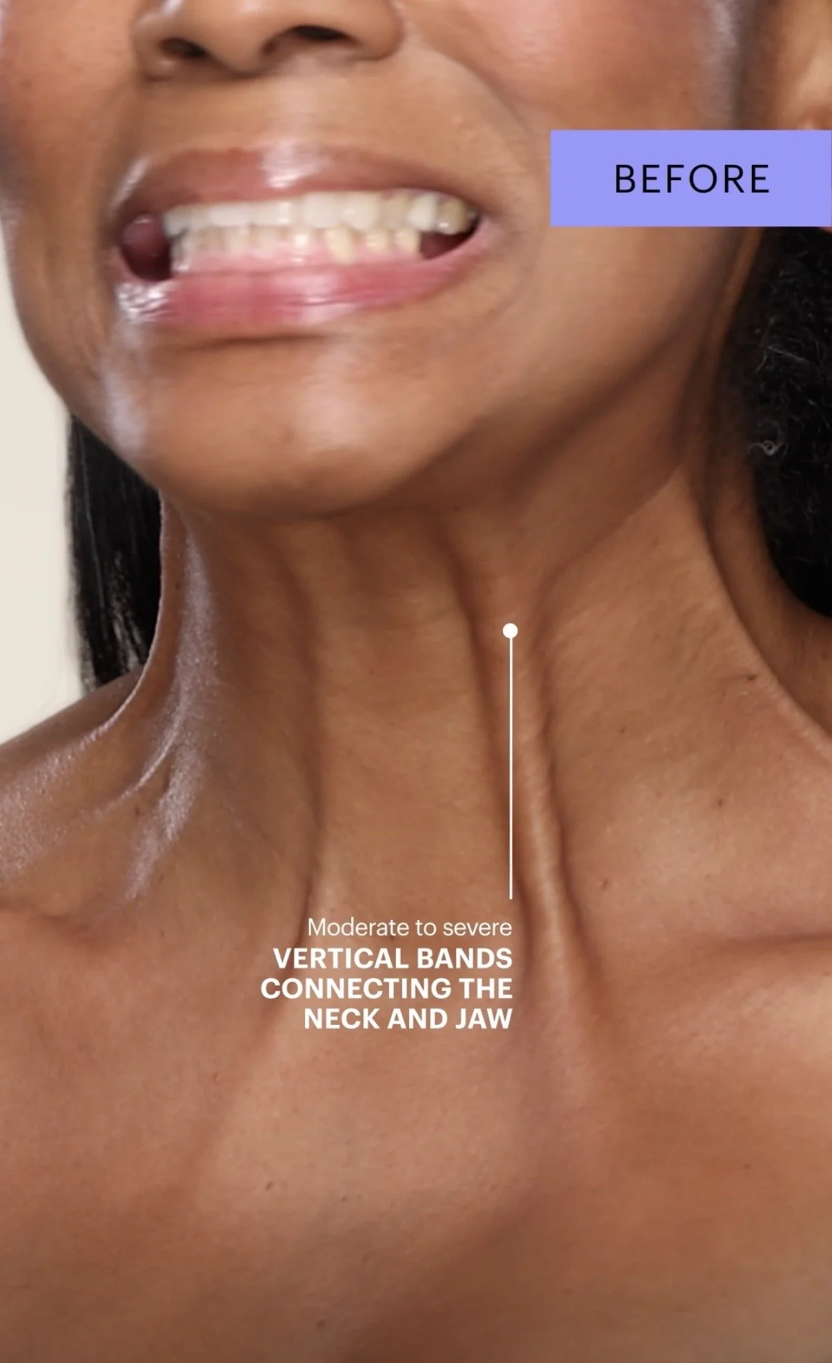 Neck tightening, Platysma bands