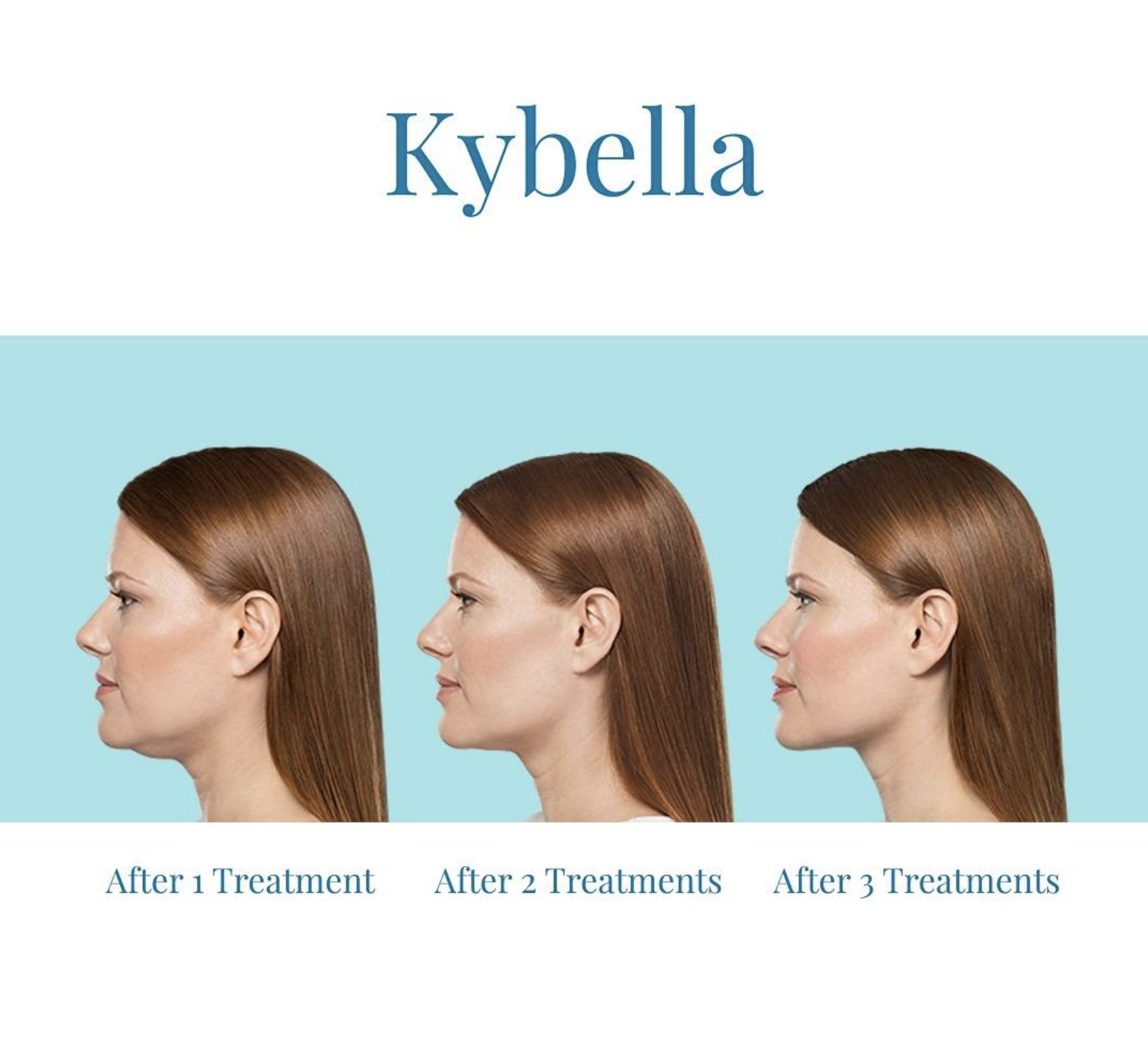 Kybella before and after chart