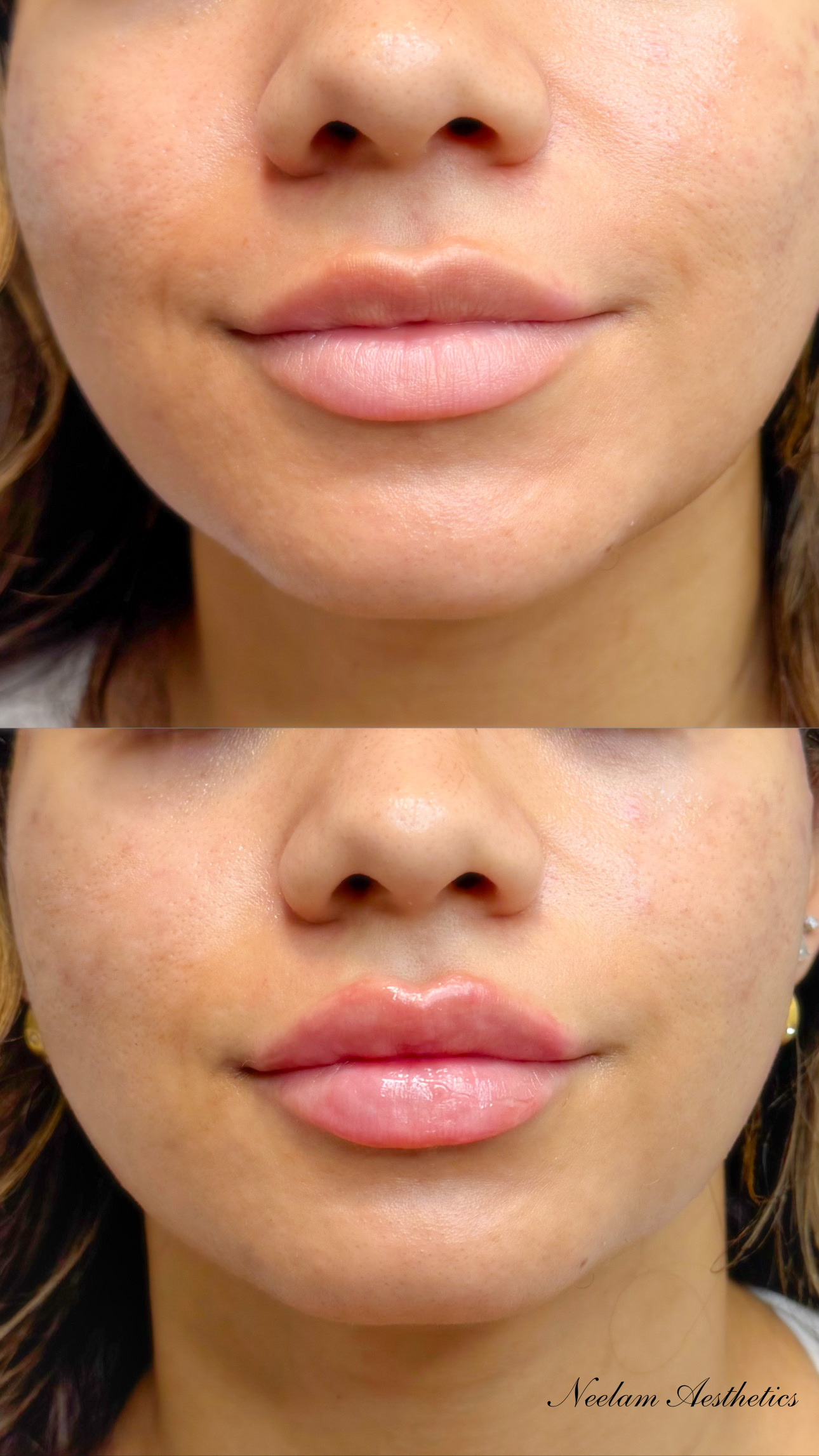 Lip Filler
