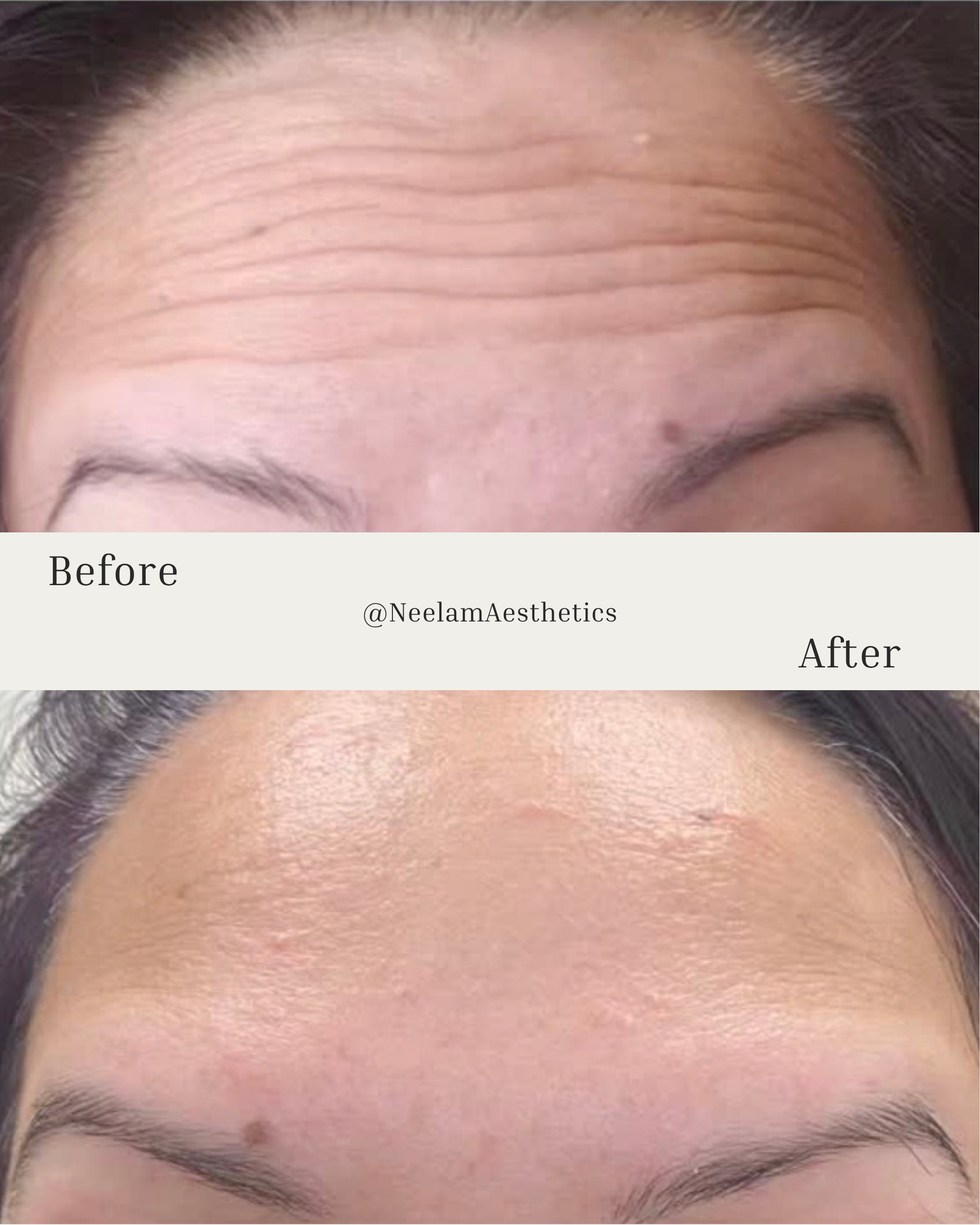 forhead botox, wrinkle treatment