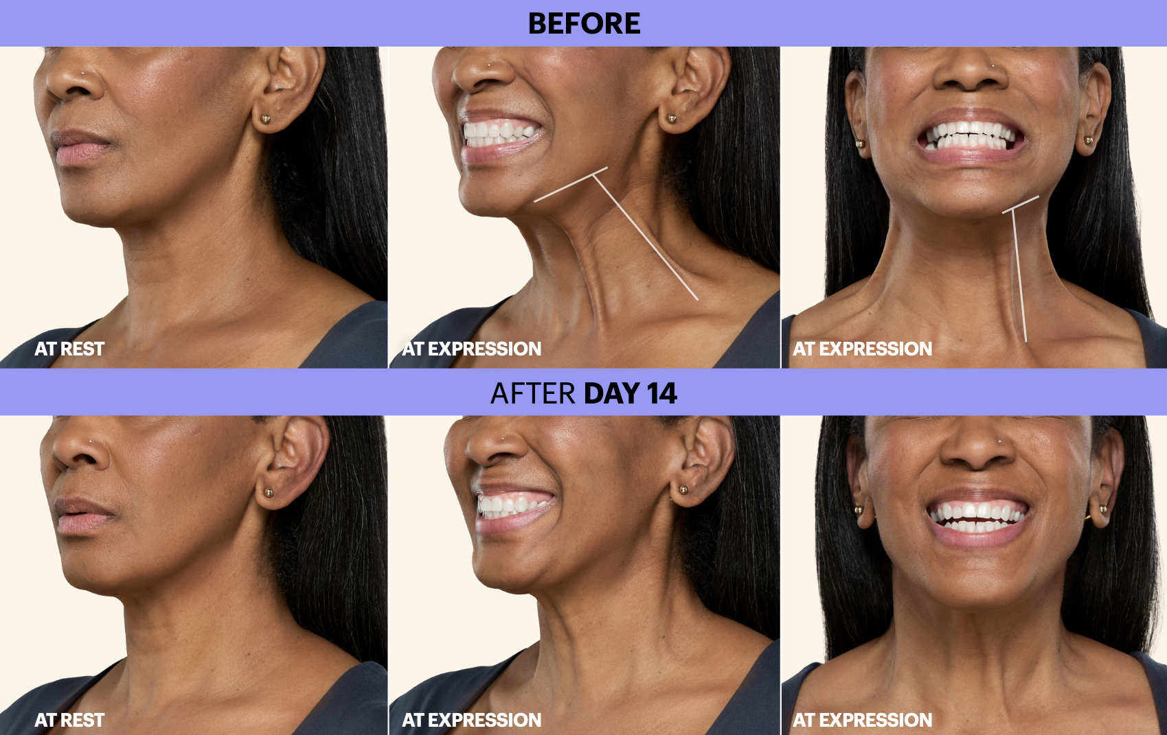 before and after neck tightening treatment