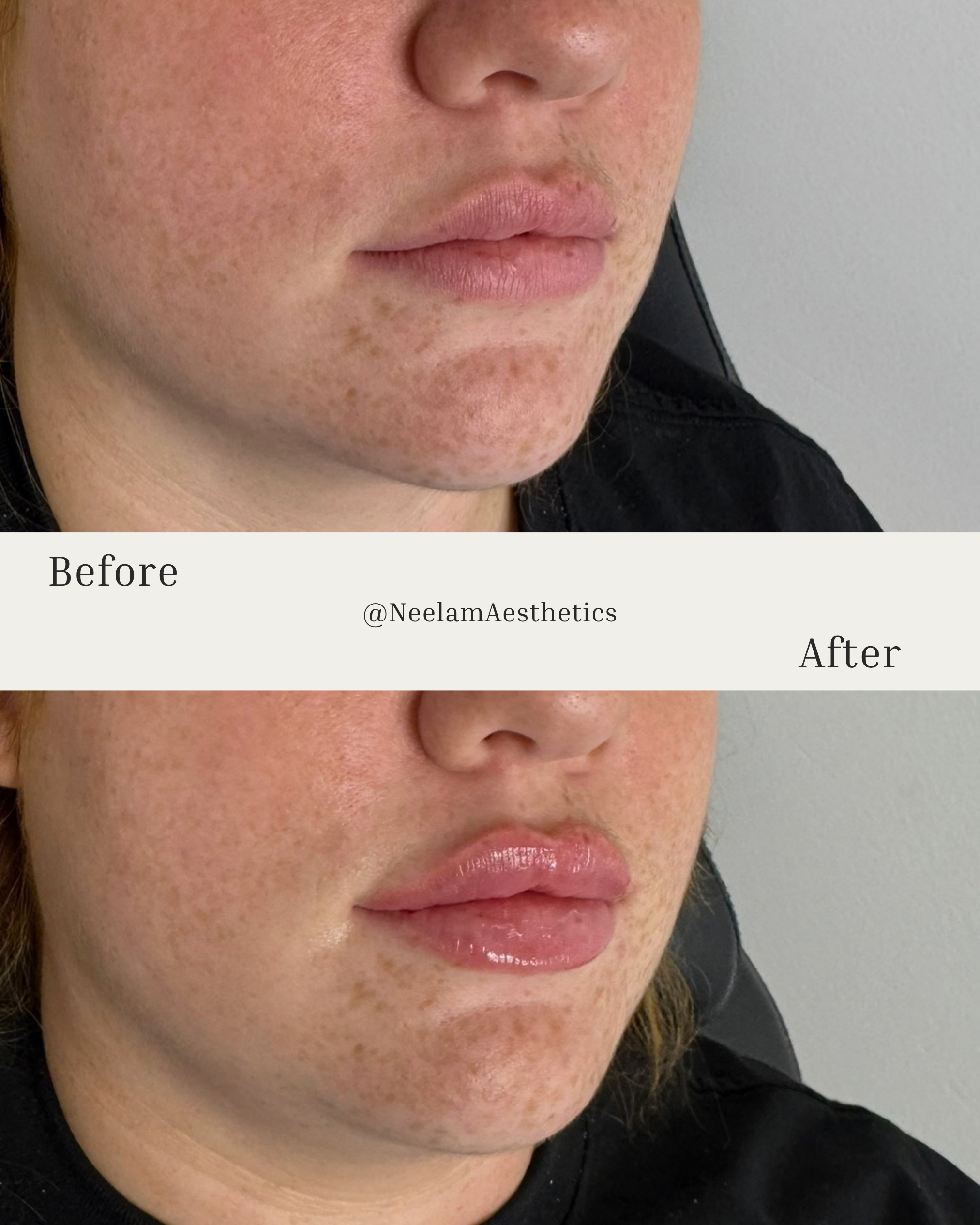 facial balancing, filler, chin filler