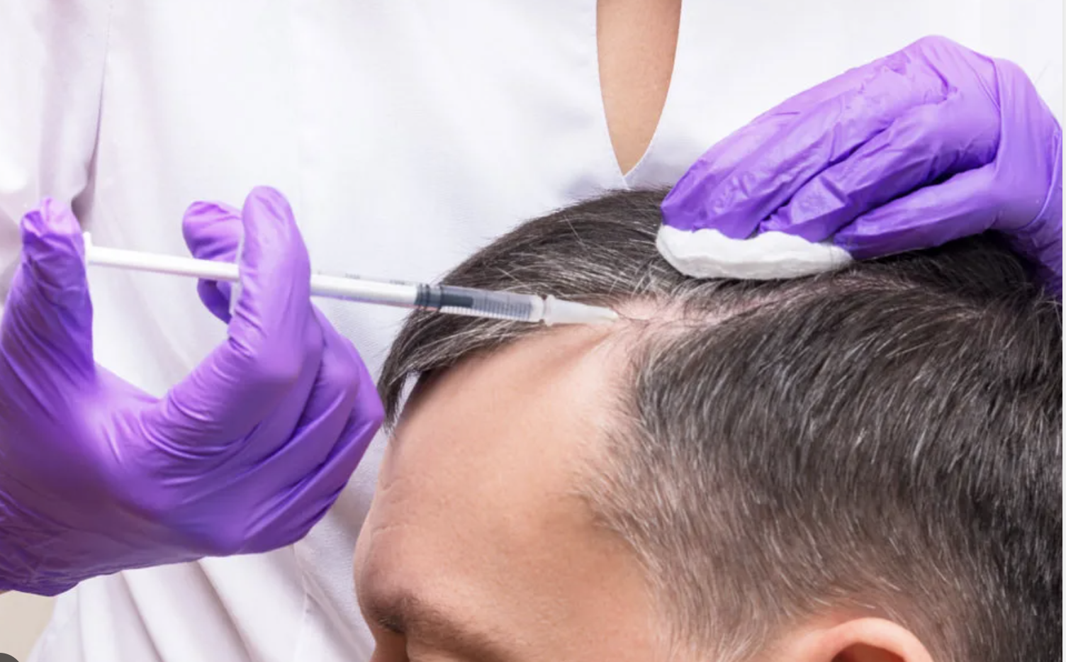 Hair Restoration Growth Treatment