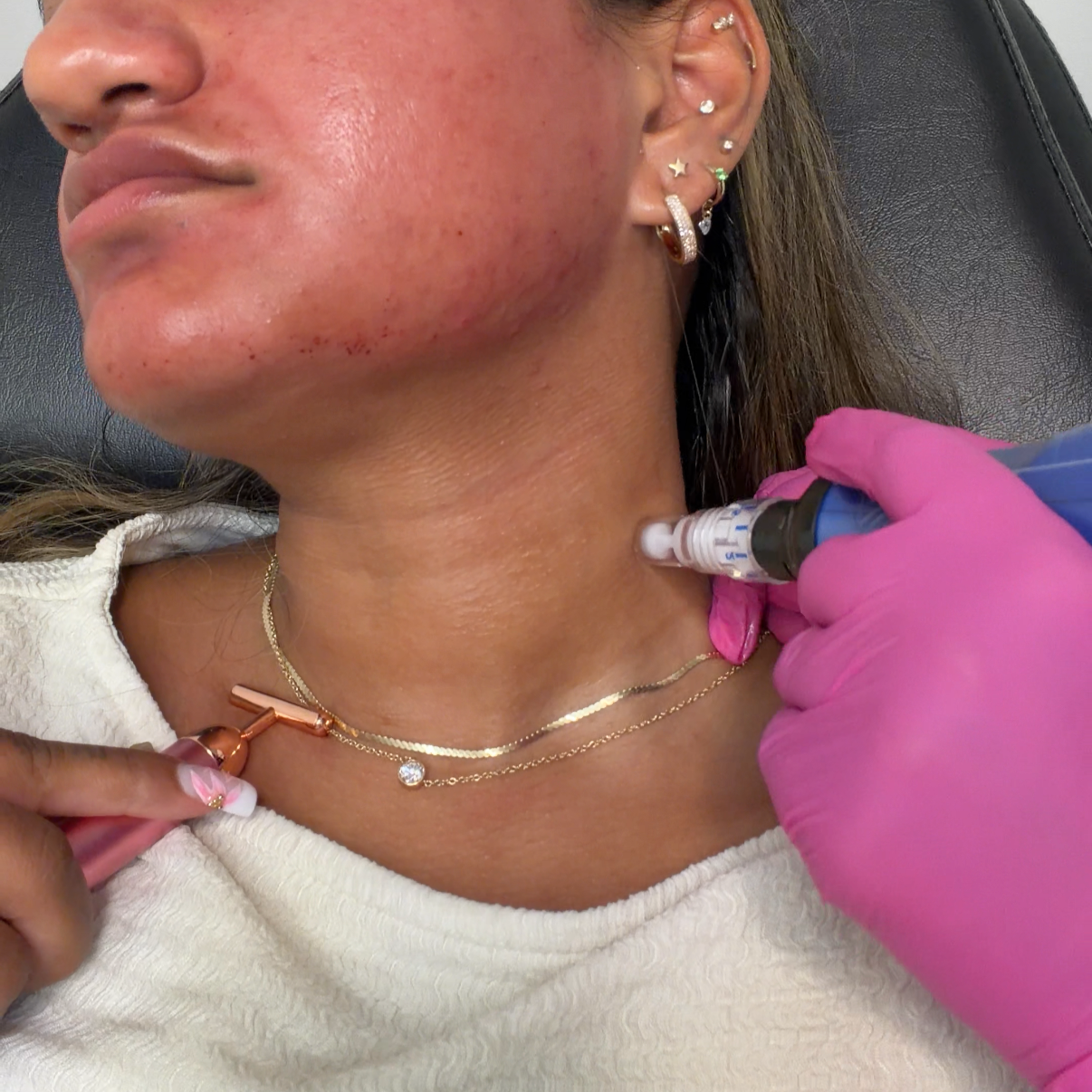 Microneedling Face and neck