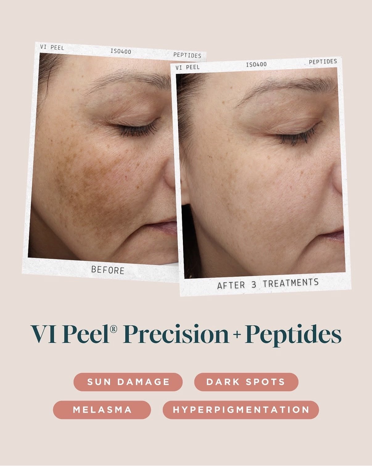 VI Chemical Peel Precision + Peptide