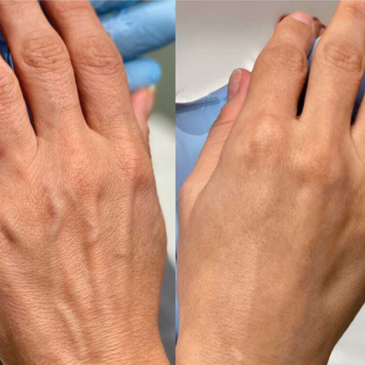 hand rejuvenation