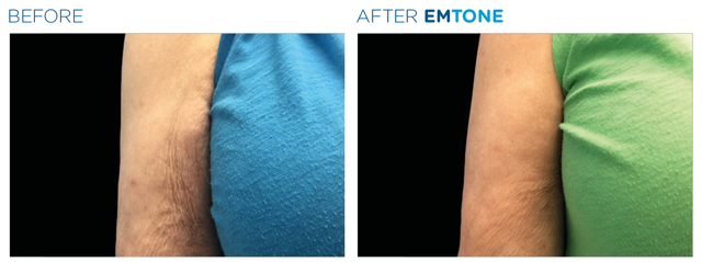 Emtone/Skin Tightening